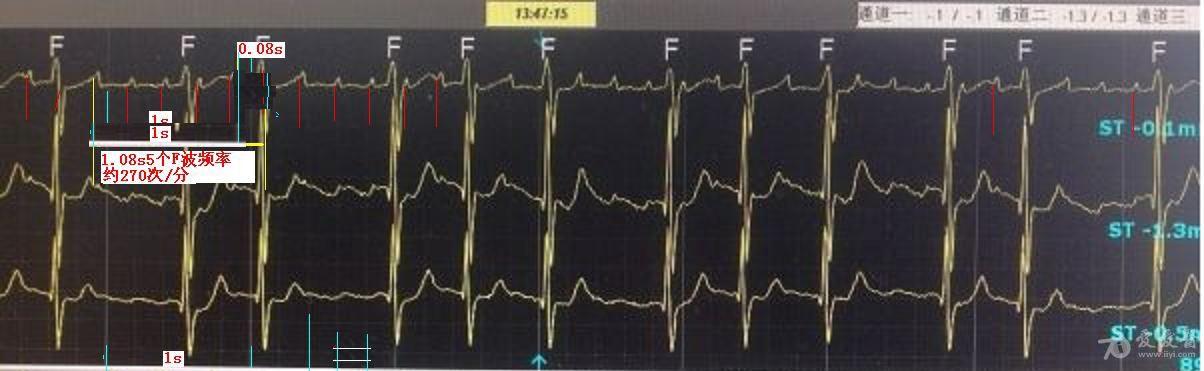 这个又是什么 心电图脑电图专业讨论版 爱爱医医学论坛