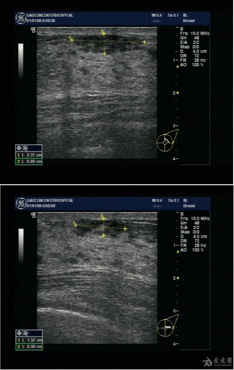 乳腺 超声医学讨论版 爱爱医医学论坛