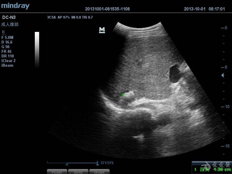 肝内胆管结石彩超图片图片