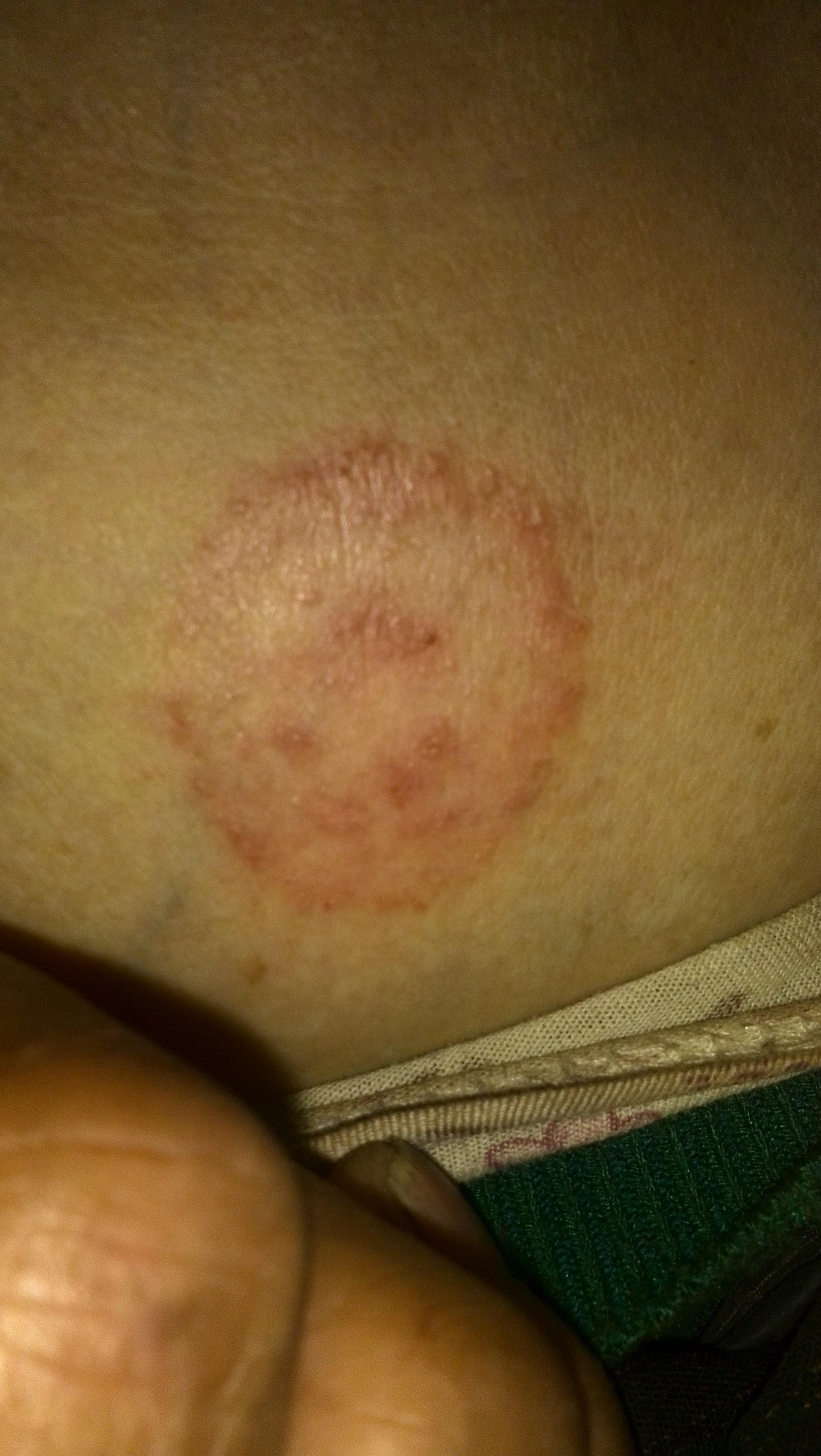 铜钱大小的红斑是什么