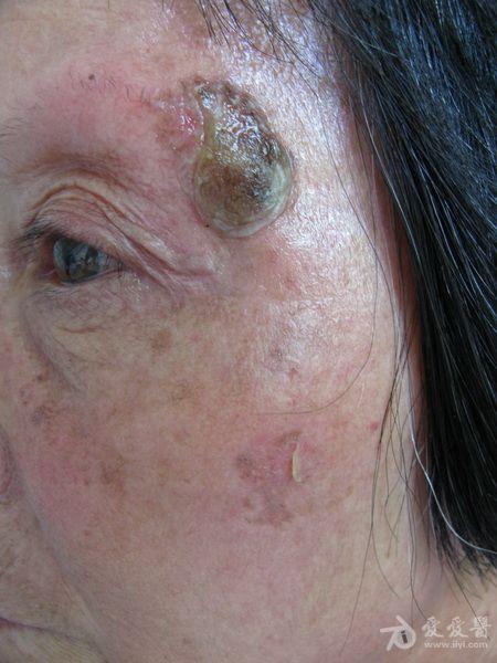血癌早期皮肤图片图片