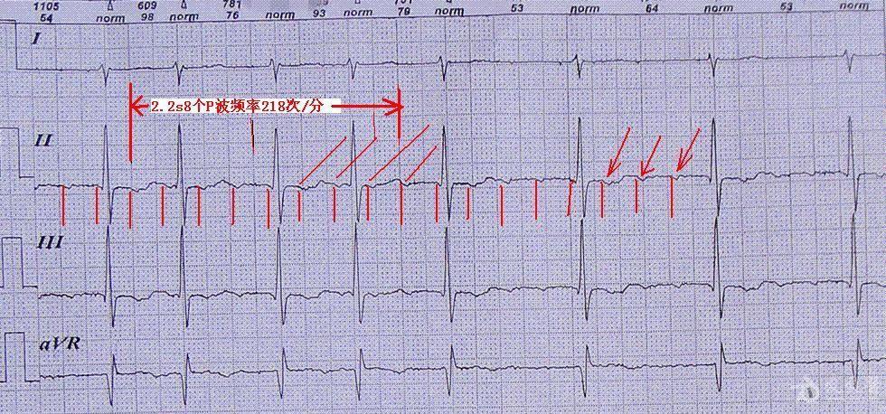 房扑心电图 室上速图片