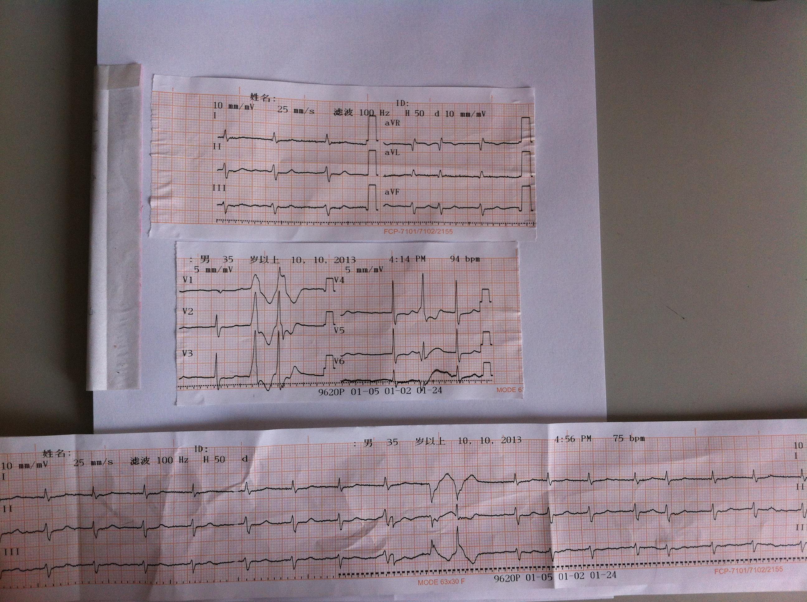 请各位老师看看房颤伴什么室早差传预激