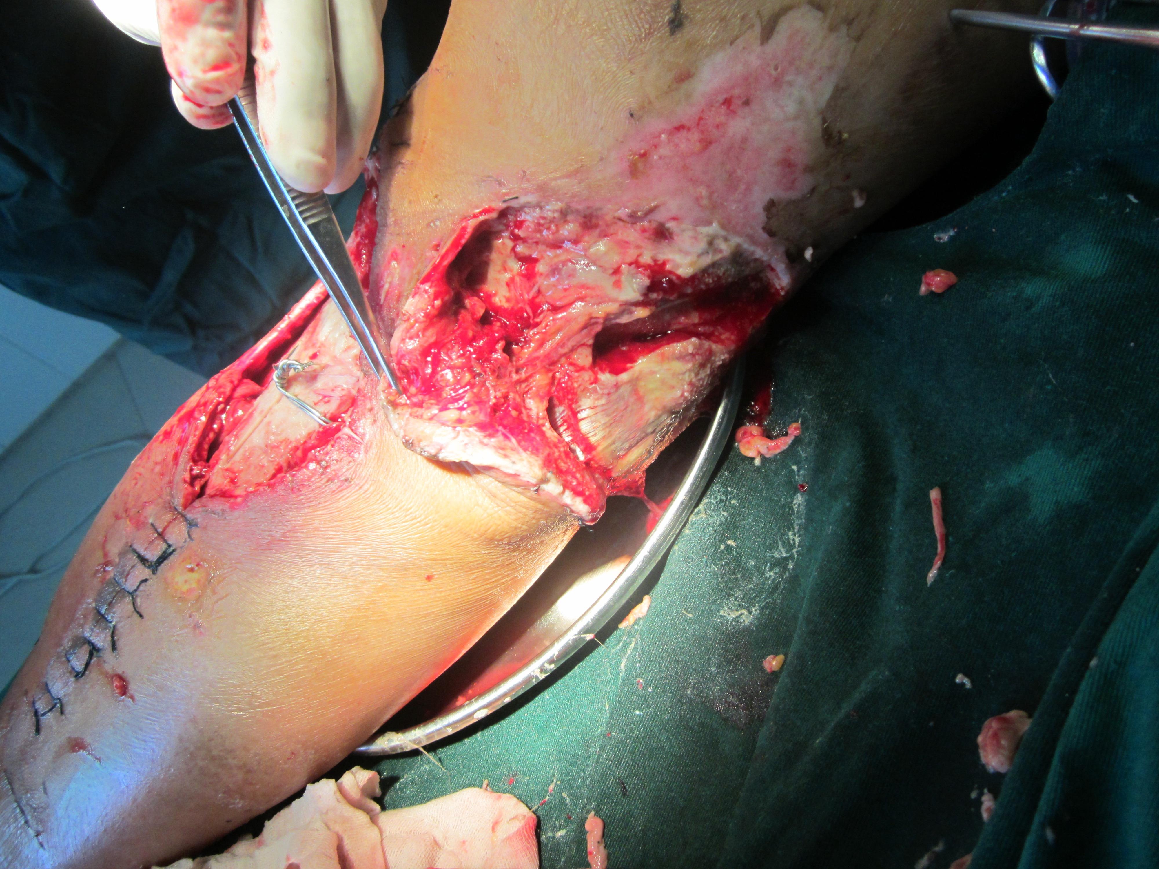 小腿毁损伤术后求进一步治疗方案