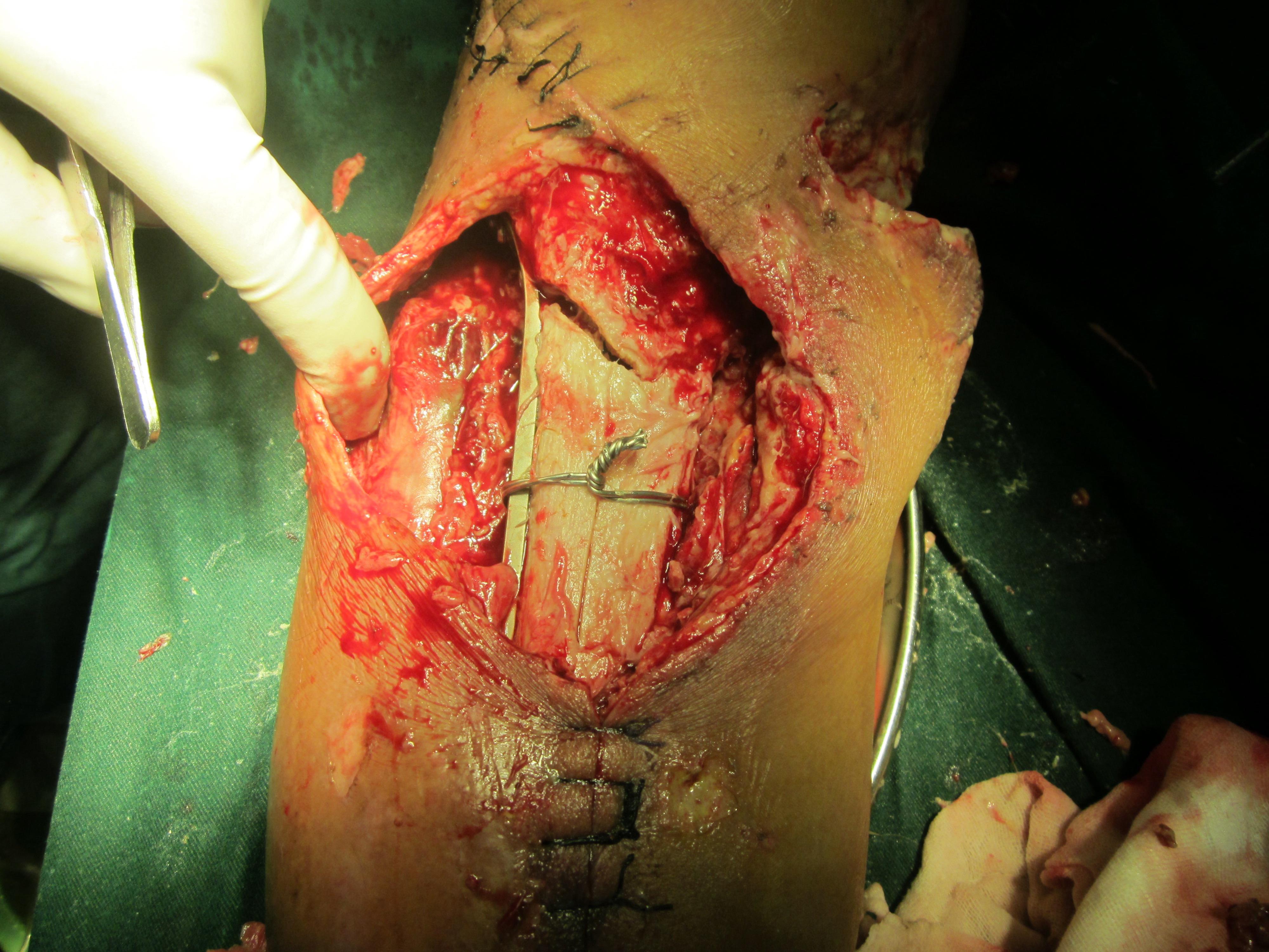 小腿毁损伤术后求进一步治疗方案