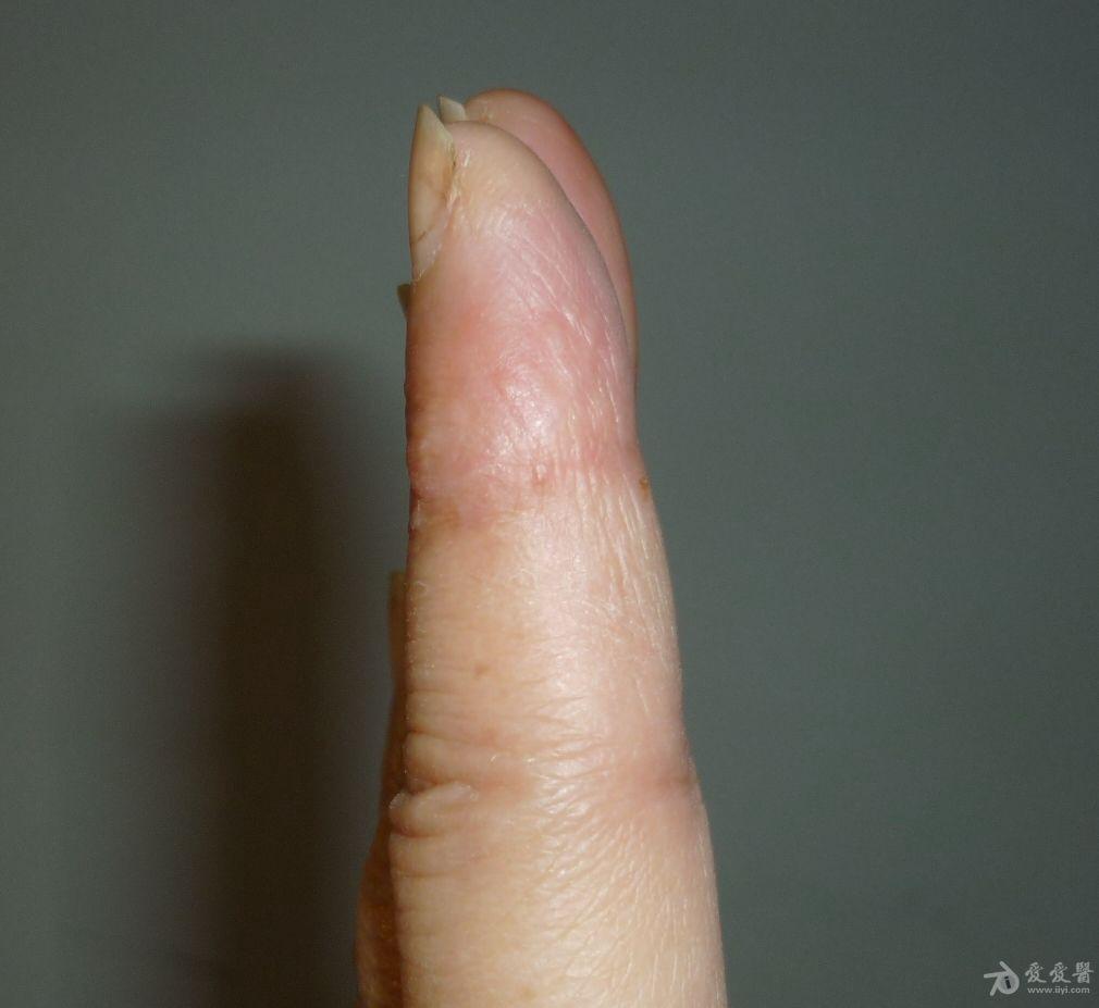 求助:手指外伤后针眼凸起怎么办?