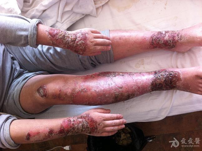 一例典型聚合性痤疮,出现窦道,囊肿