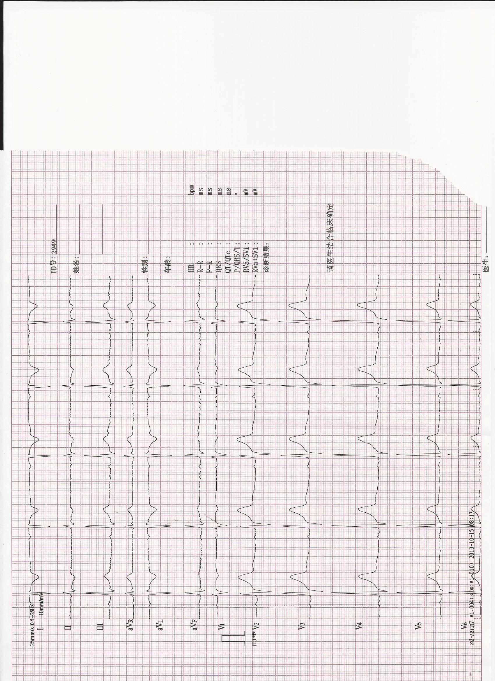 麻煩大家看一下心電圖