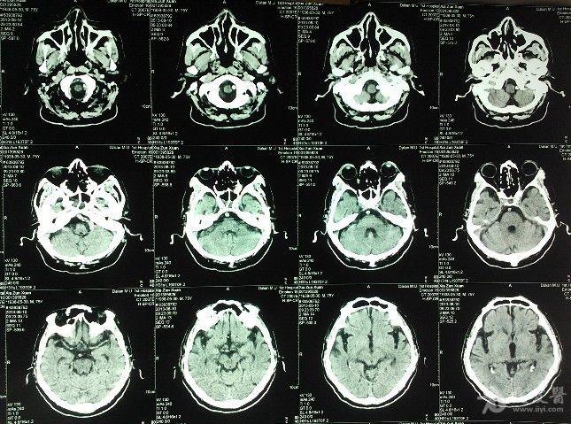 1例眩暈站立不穩的腦ct