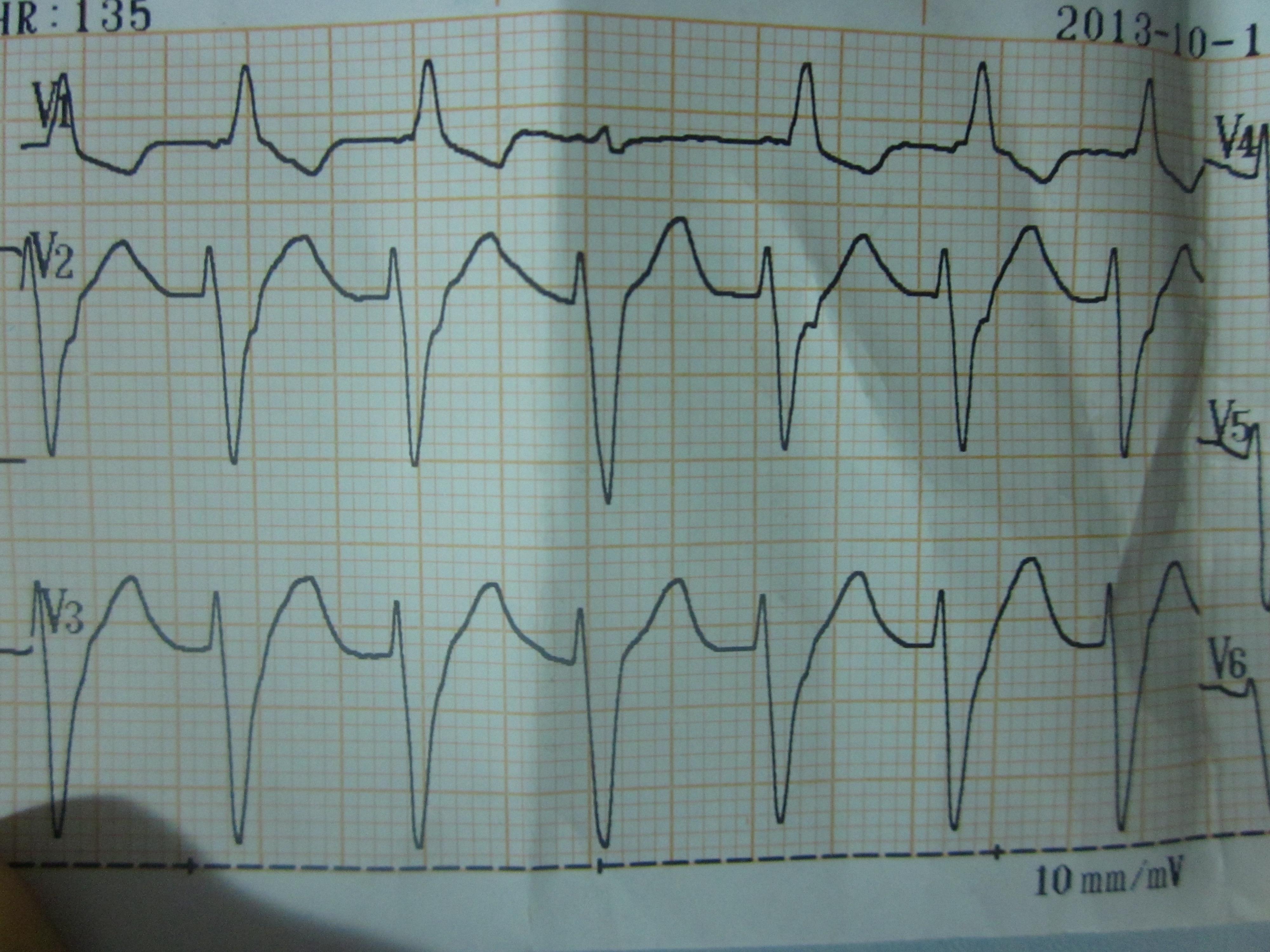 心跳过快心电图图片