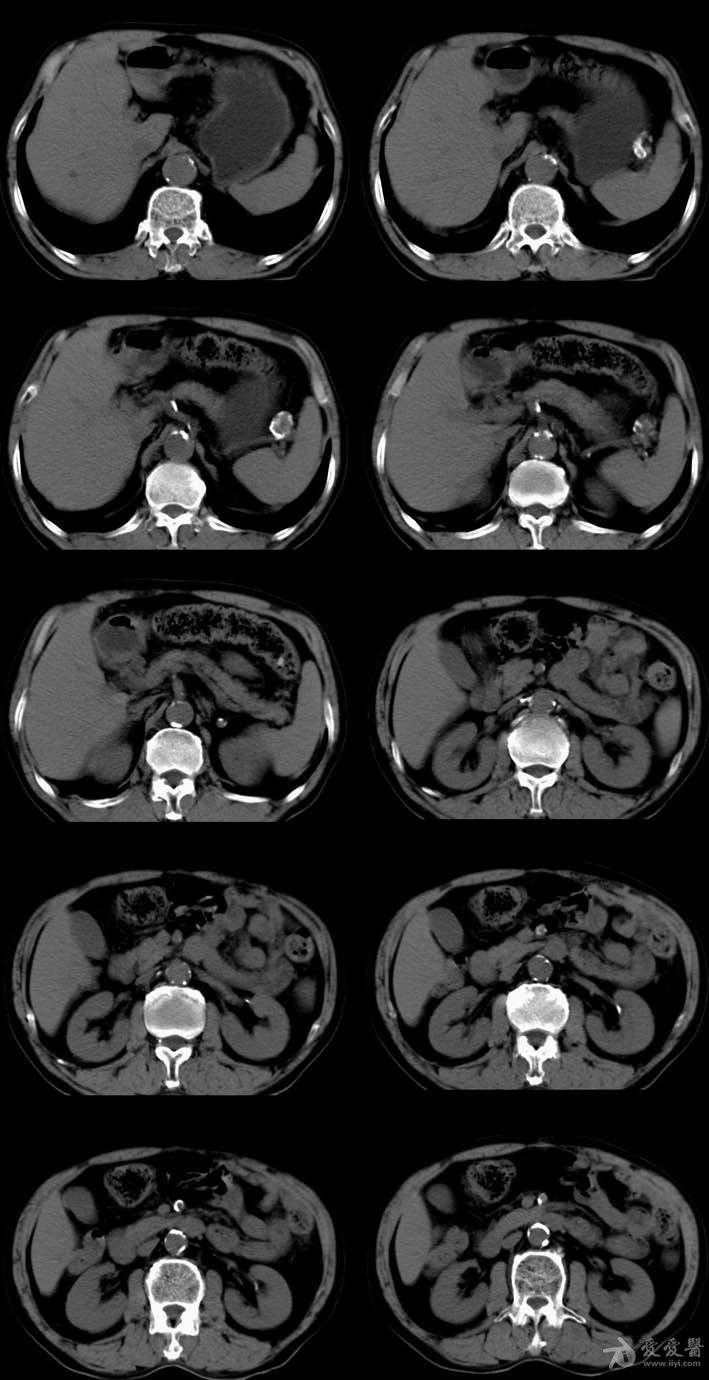 【共享】基层医院平扫经手术证实为脾动脉瘤一例.