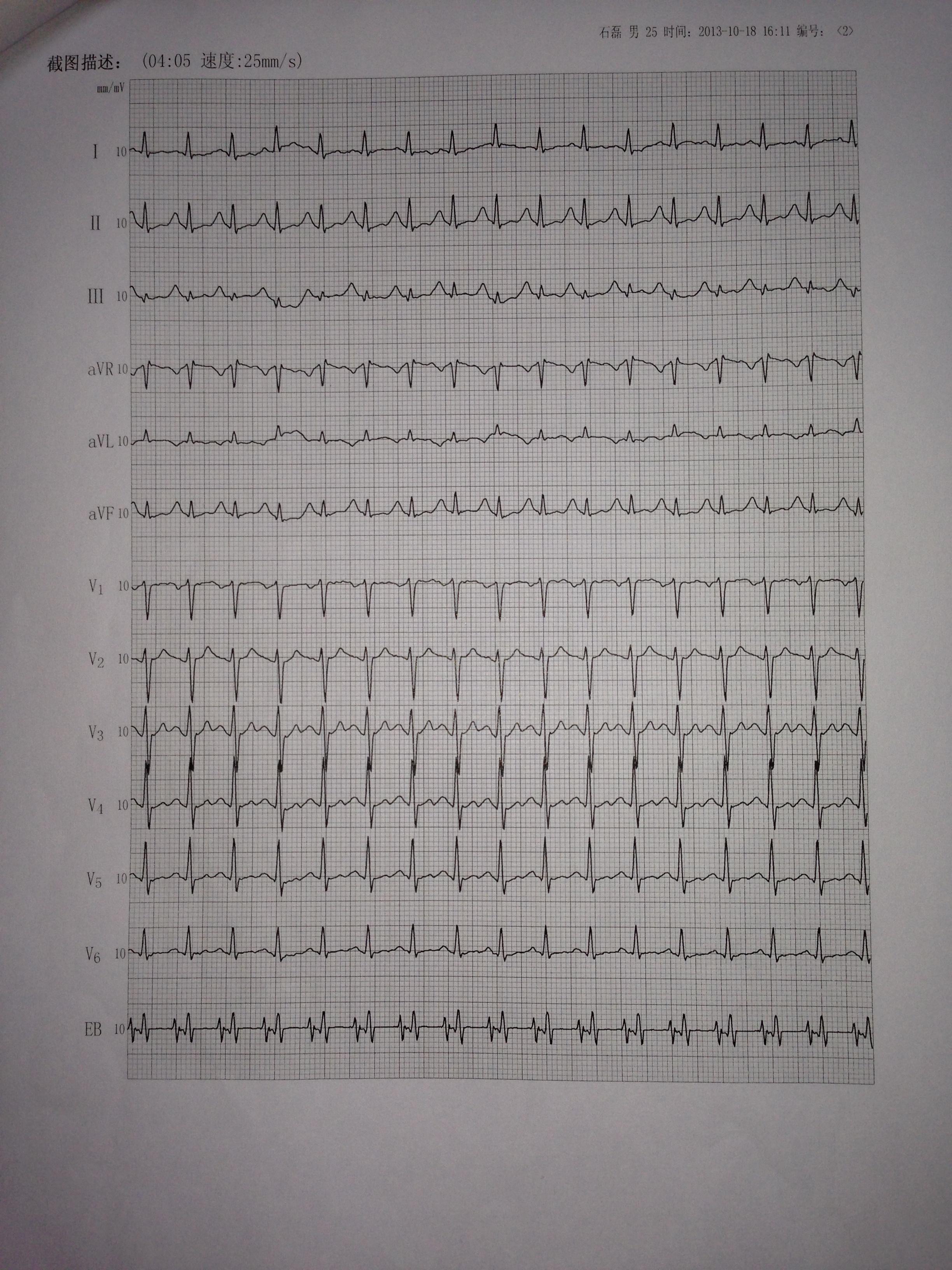 窦性心律边缘心电图图片