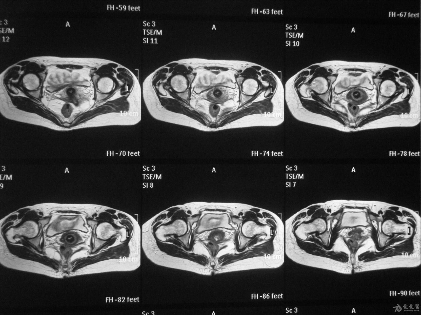 髋关节mri