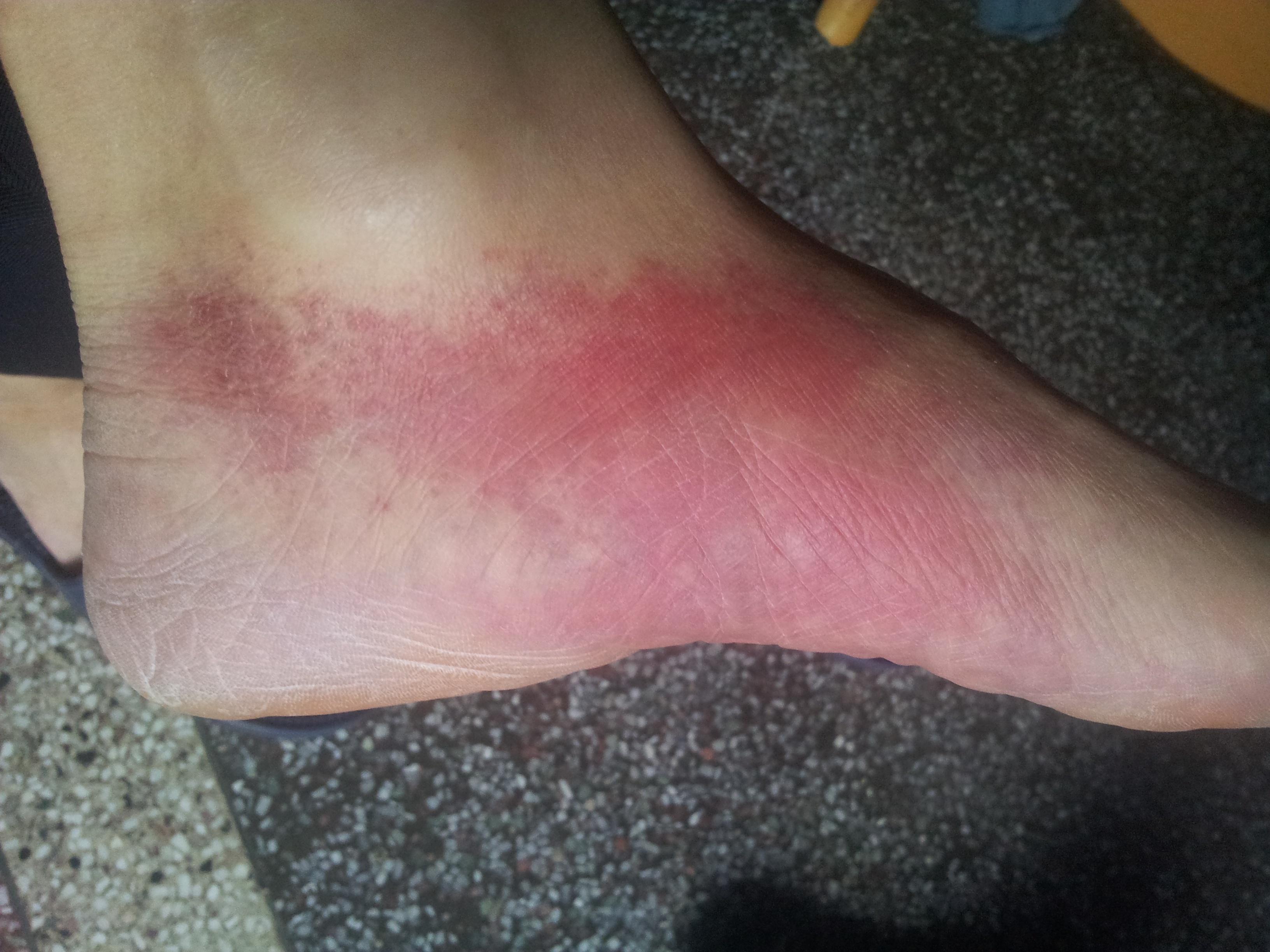 脚踝圆圈状红斑图片