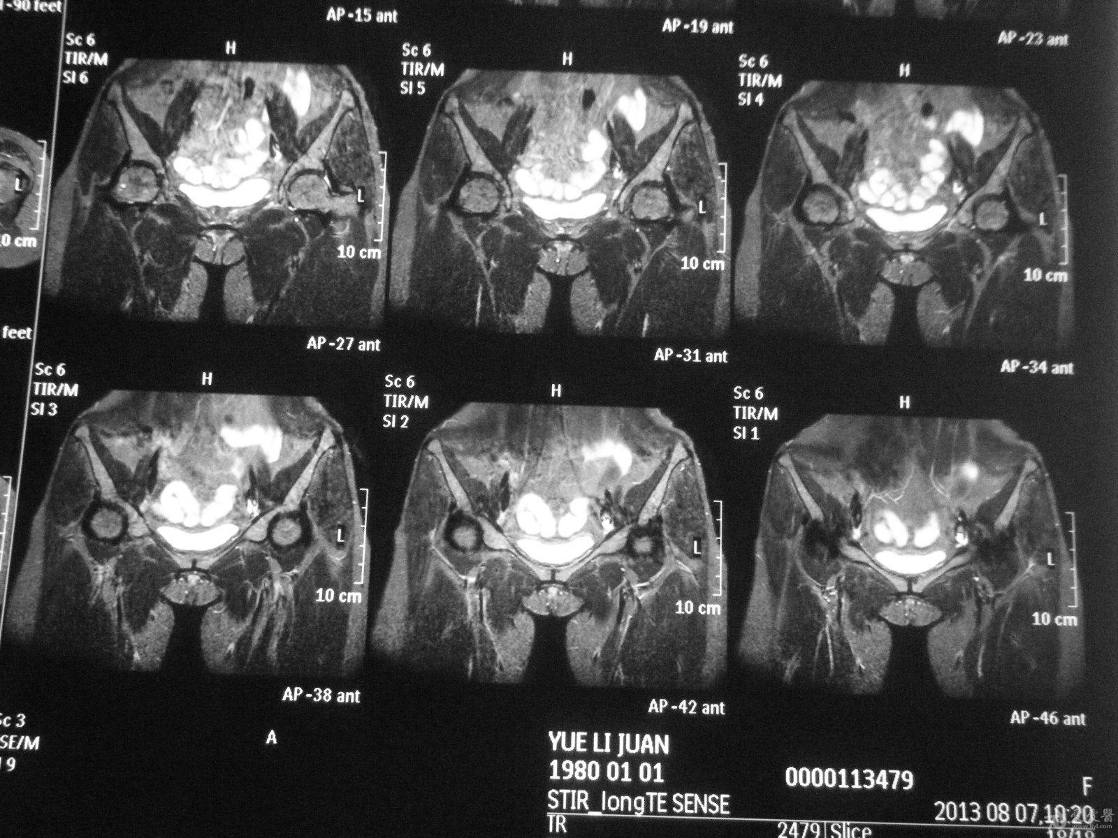 髋关节mri