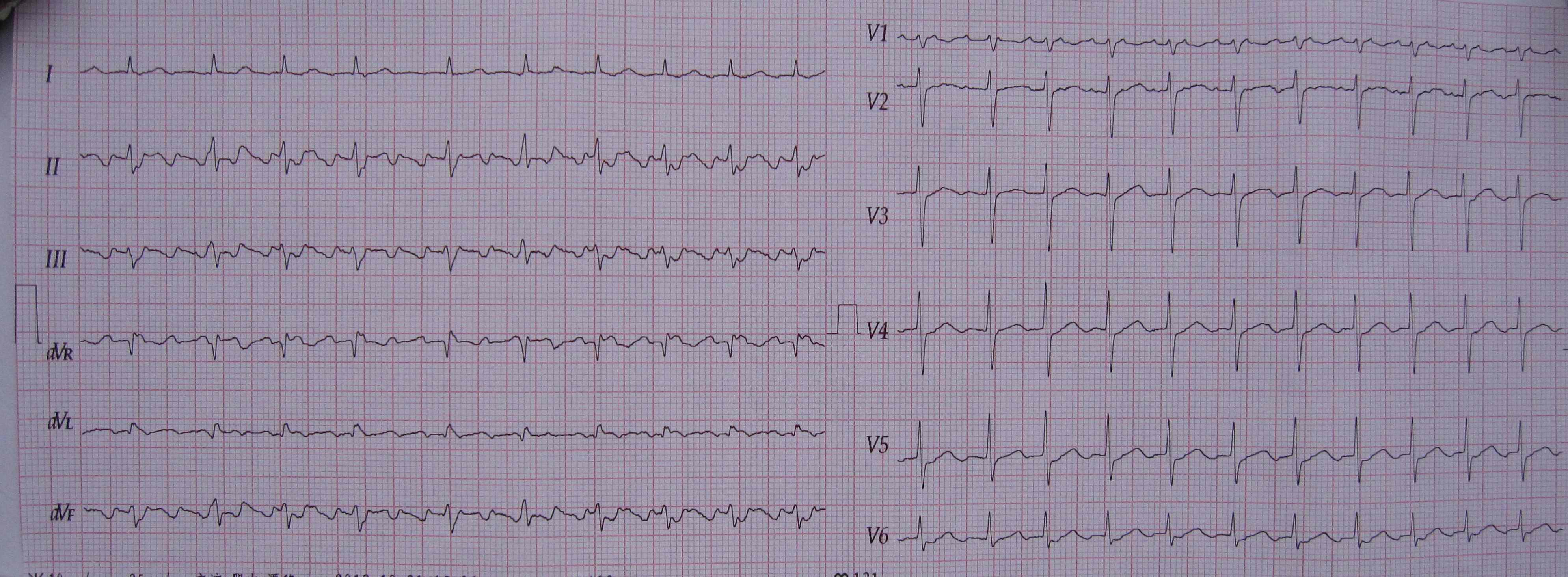 一個病人的兩次心電圖檢查 - 心電圖腦電圖專業討論版 - 愛愛醫醫學論