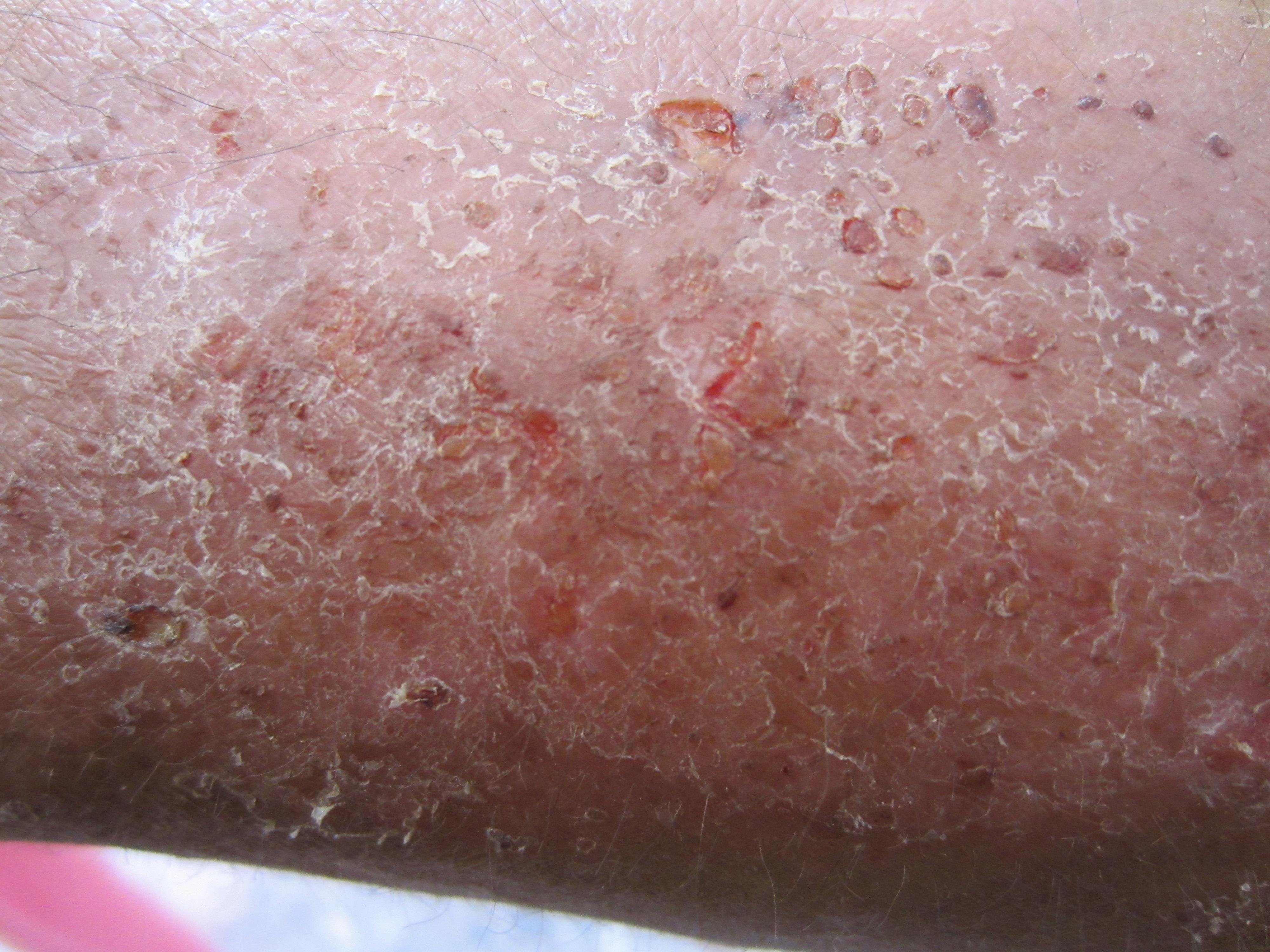 皮肤病看图那位帮看看是什么病