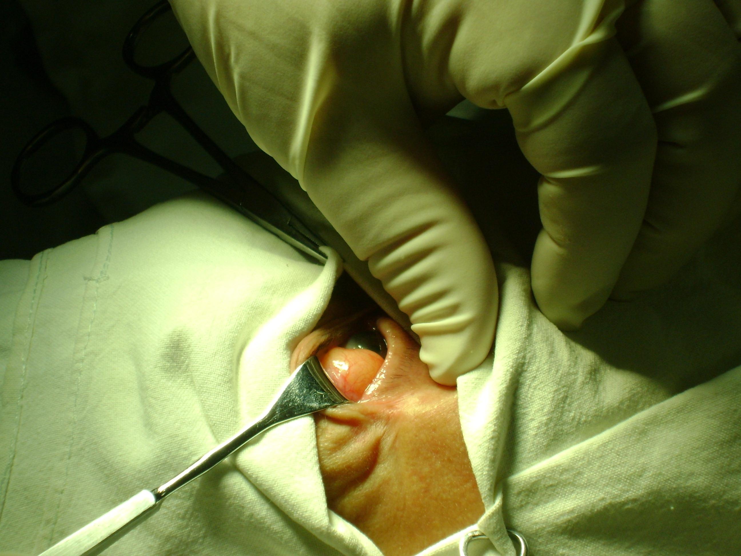 眼眶炎性假瘤手术图片图片