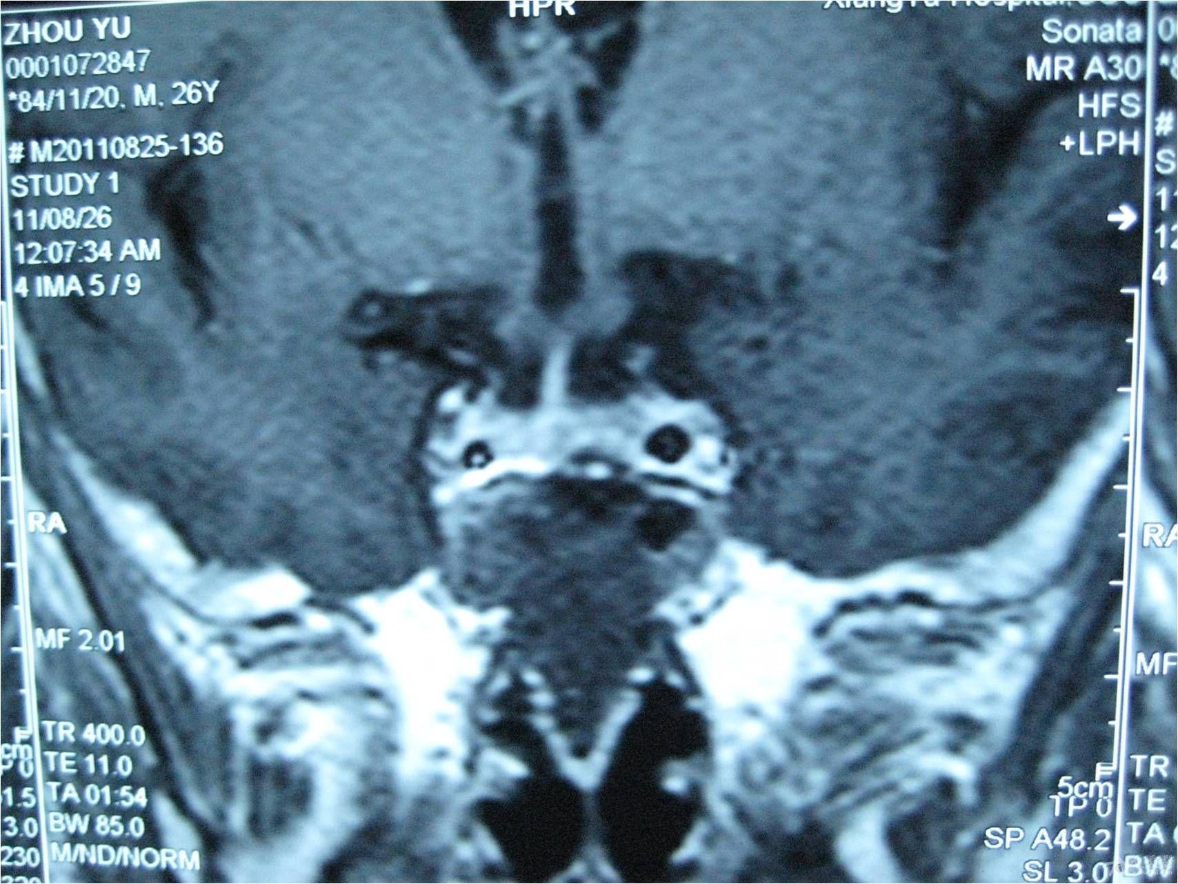 脑垂体的核磁共振检查结果请分析