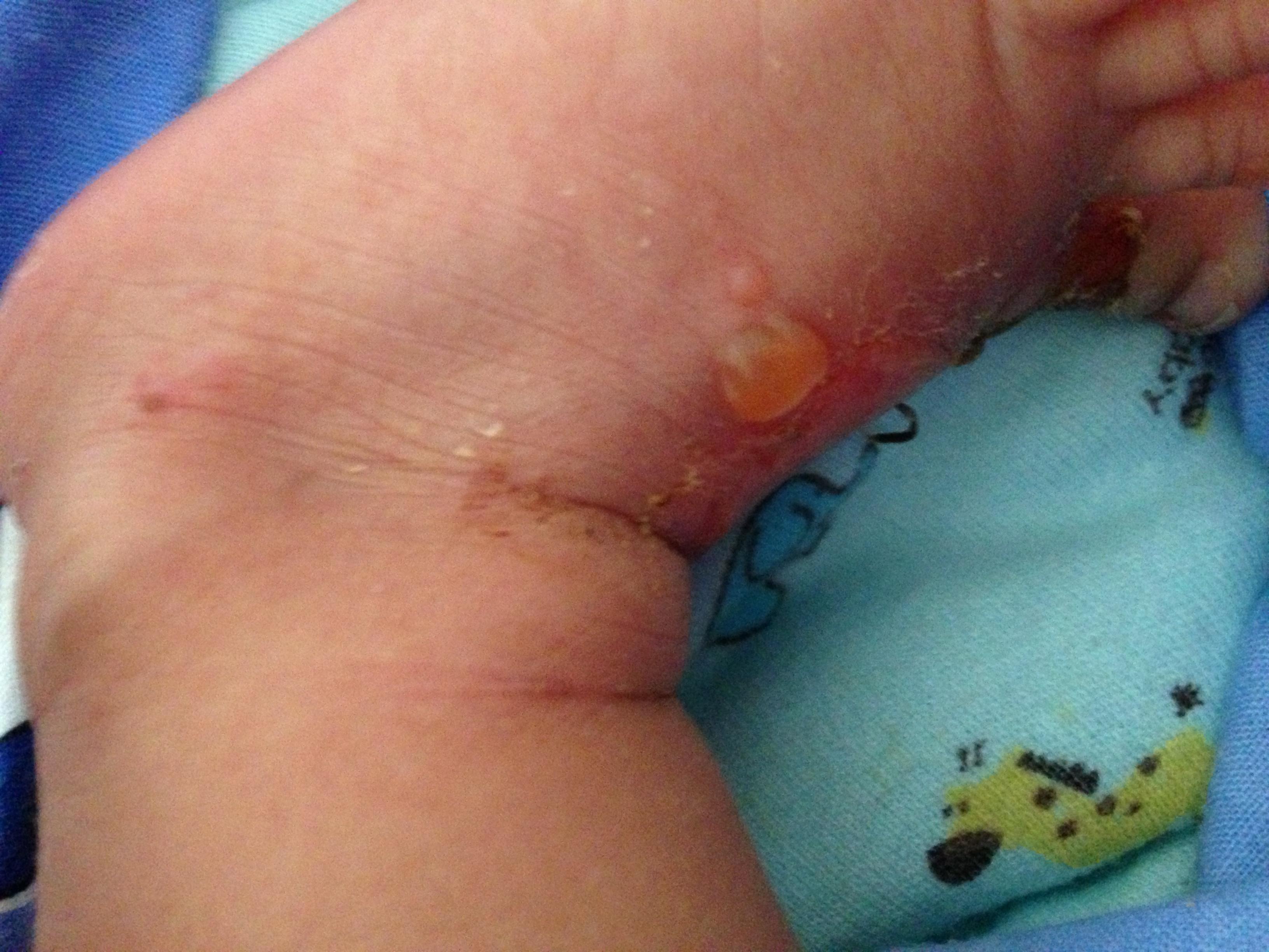 新生儿 脚上起黄色水泡,自己蹭破后 表皮脱落