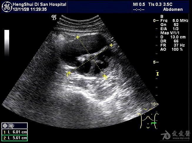 肾结核 超声医学讨论版 爱爱医医学论坛