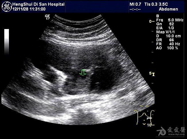 肾结核 超声医学讨论版 爱爱医医学论坛