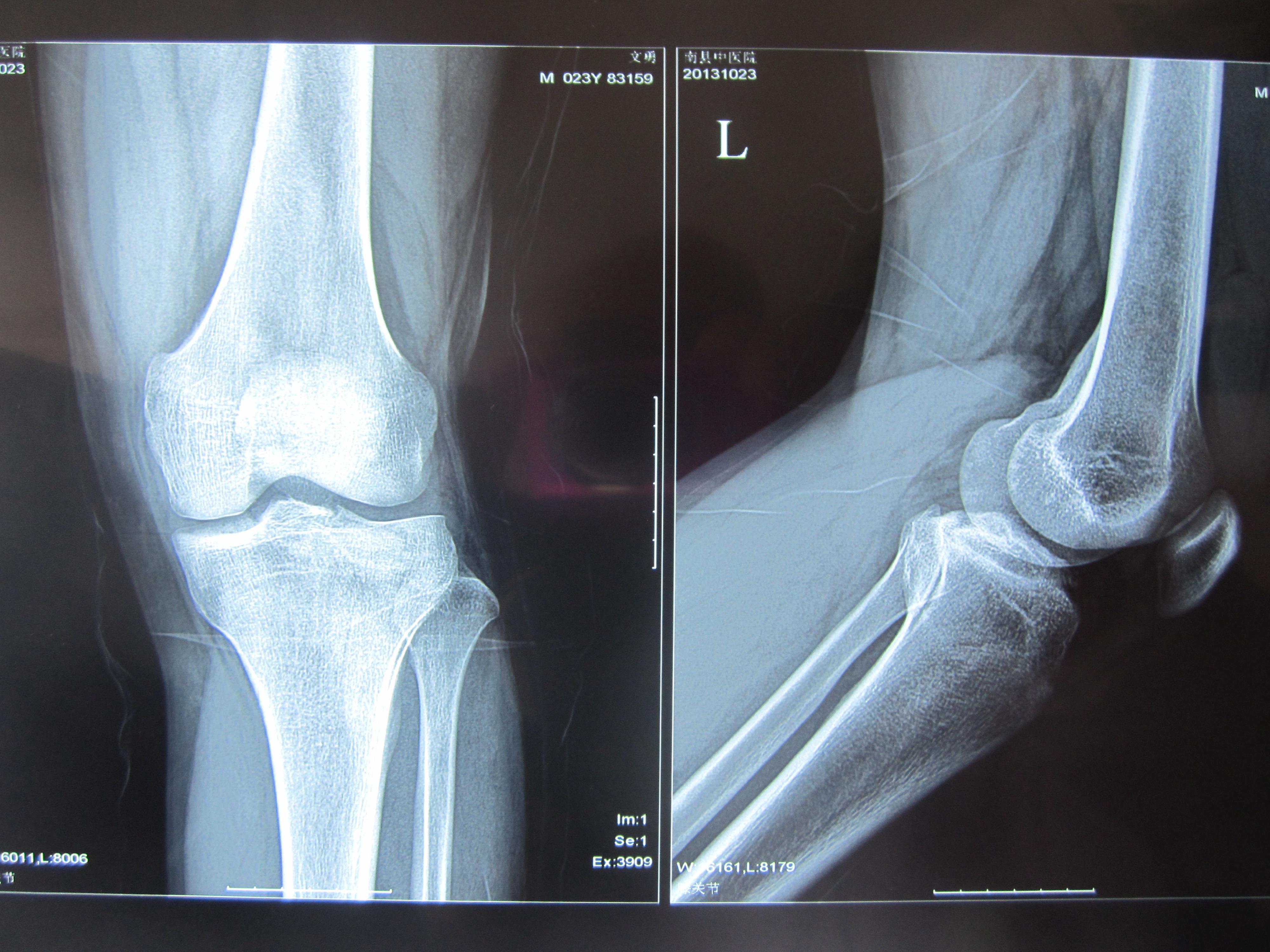 膝盖骨折照片真实图片