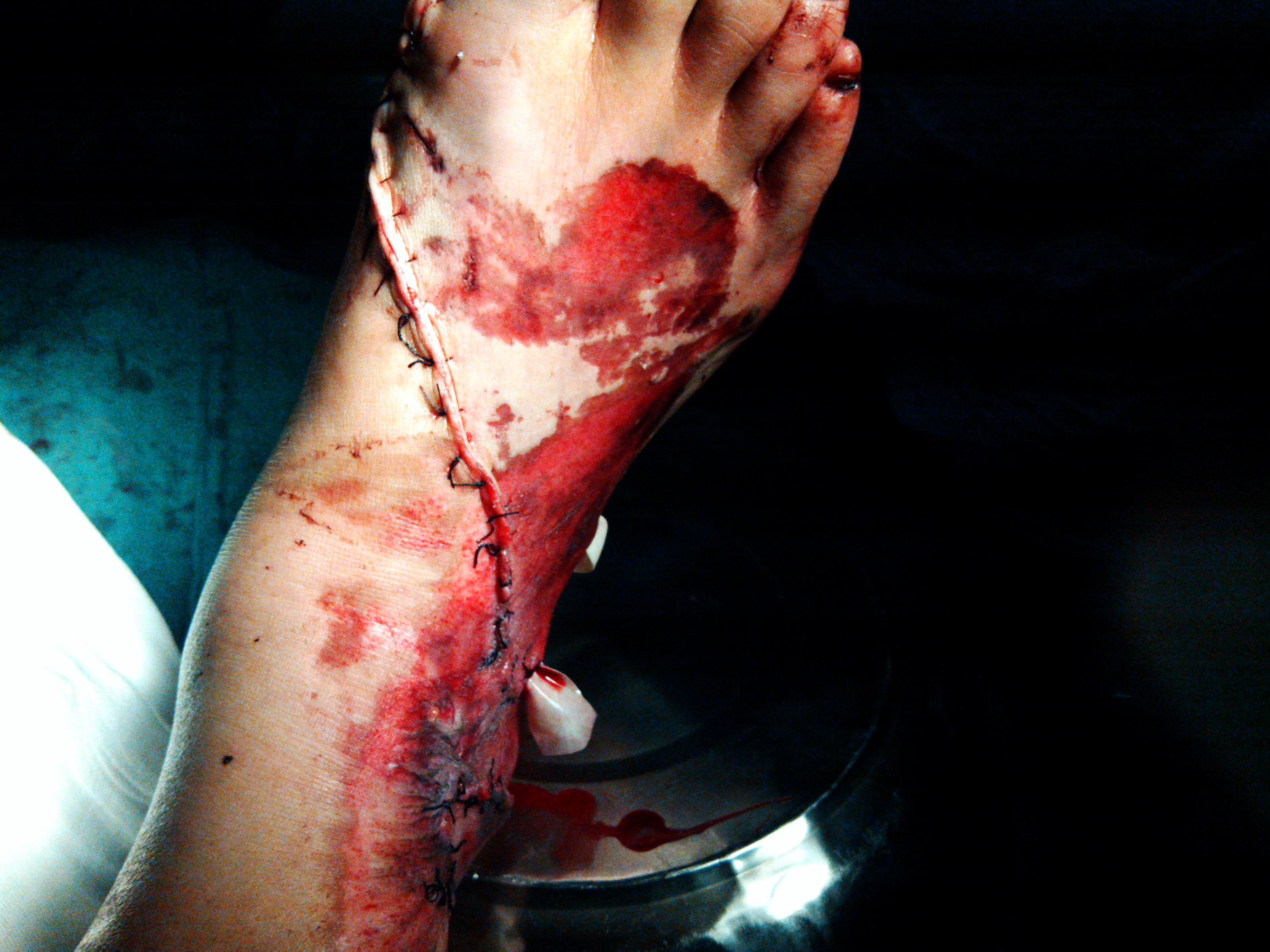 右足皮肤撕脱伤