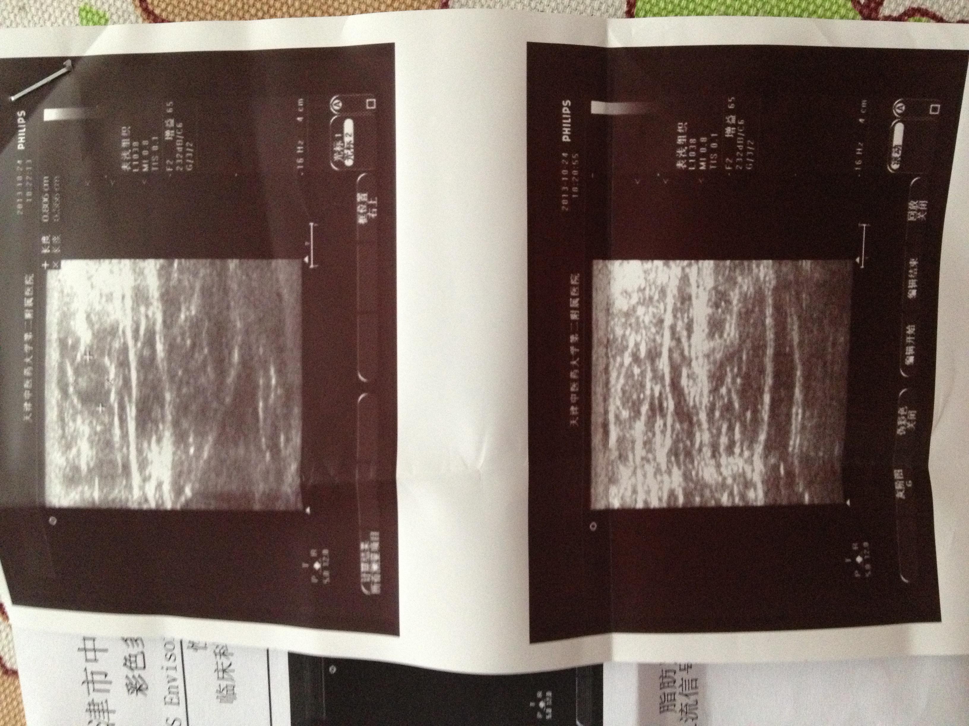 皮下脂肪瘤超声图片图片