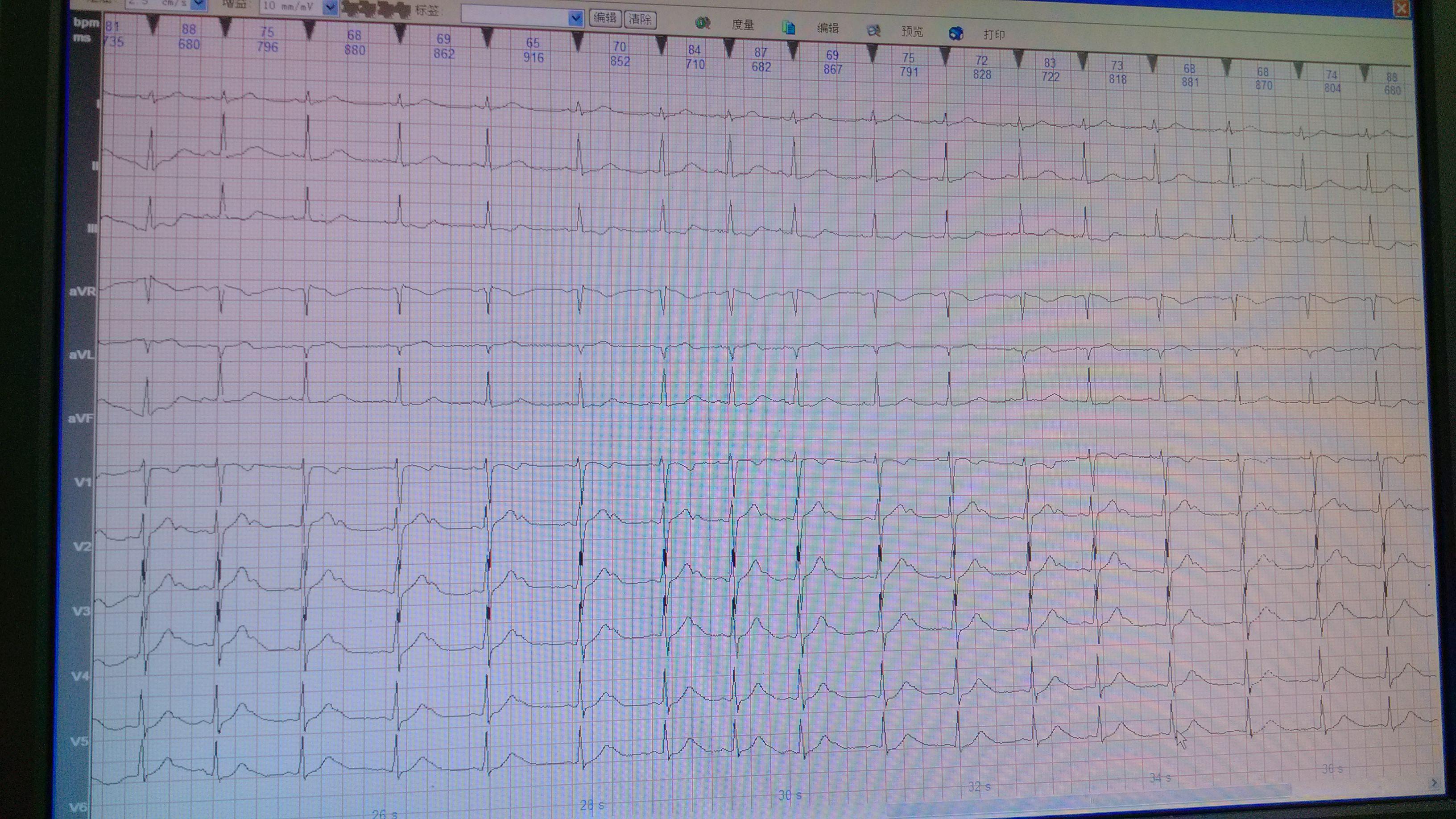 下午网络不太好,现在将12导联心电图传上