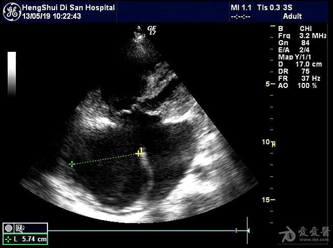 心内膜垫缺损? - 超声医学讨论版 - 爱爱医医学论坛