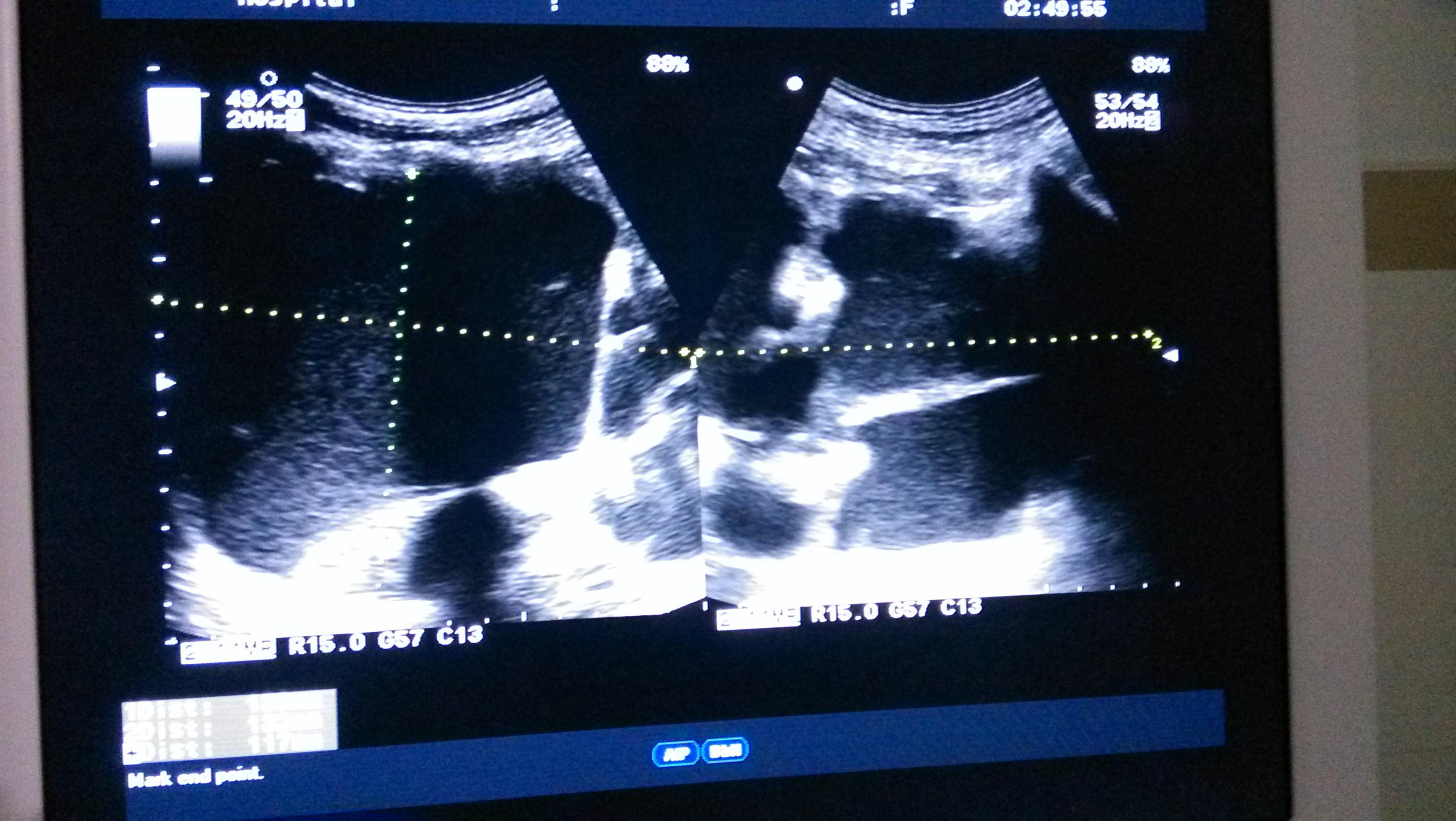 巨大积水肾 - 超声医学讨论版 - 爱爱医医学论坛