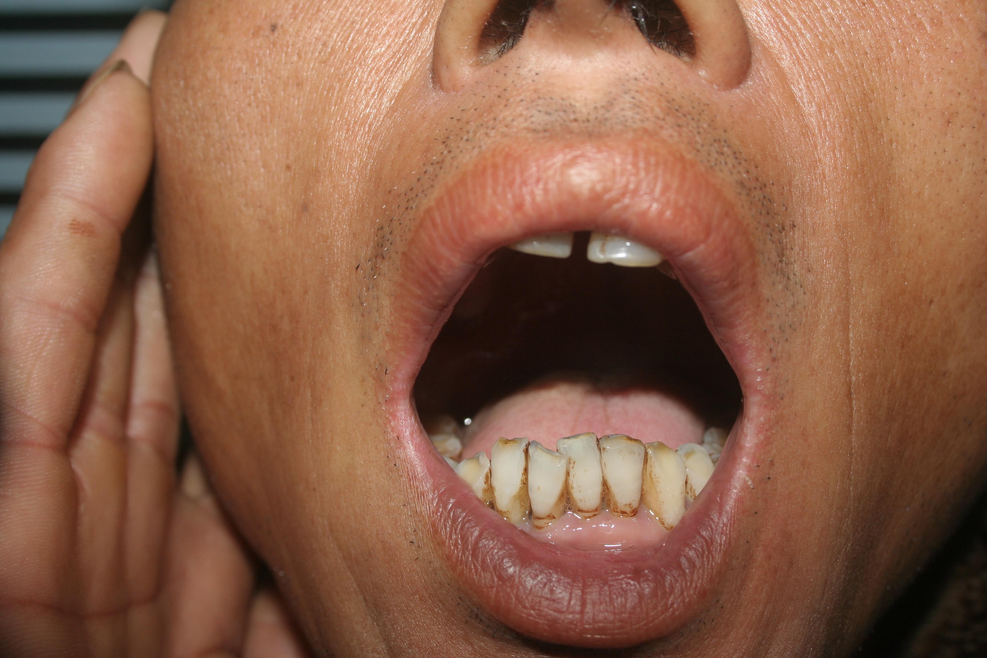 发热三天伴张口疼痛吞咽困难