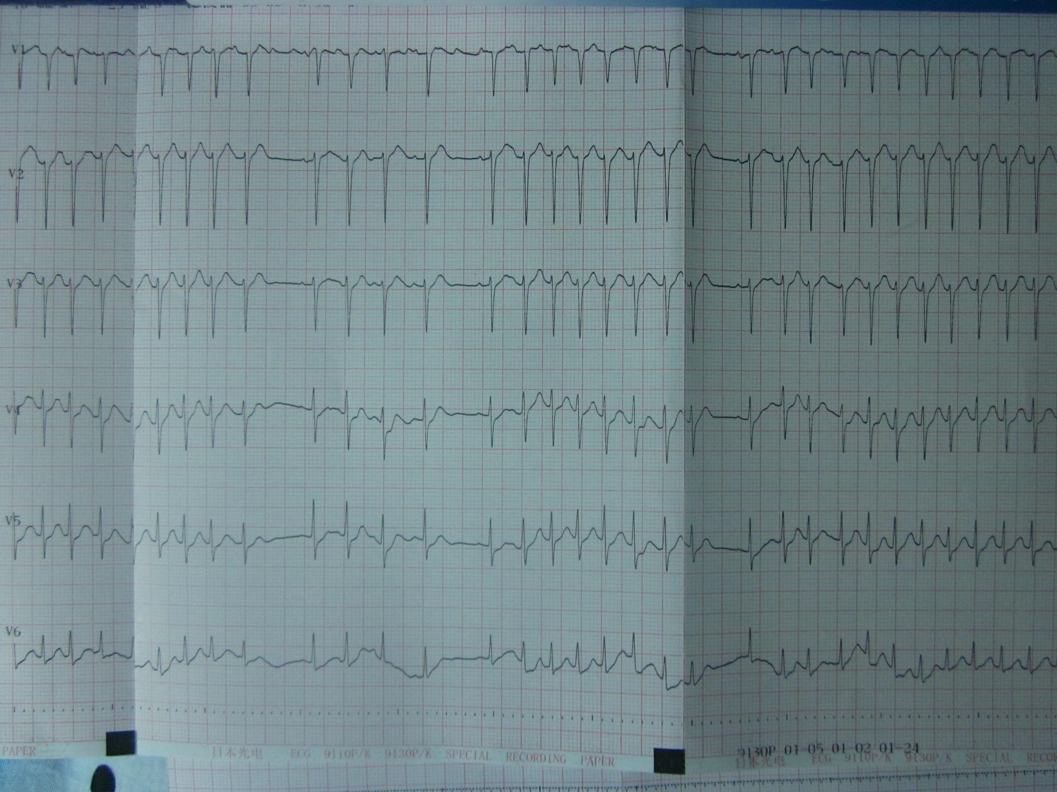 短阵房速心电图图片图片