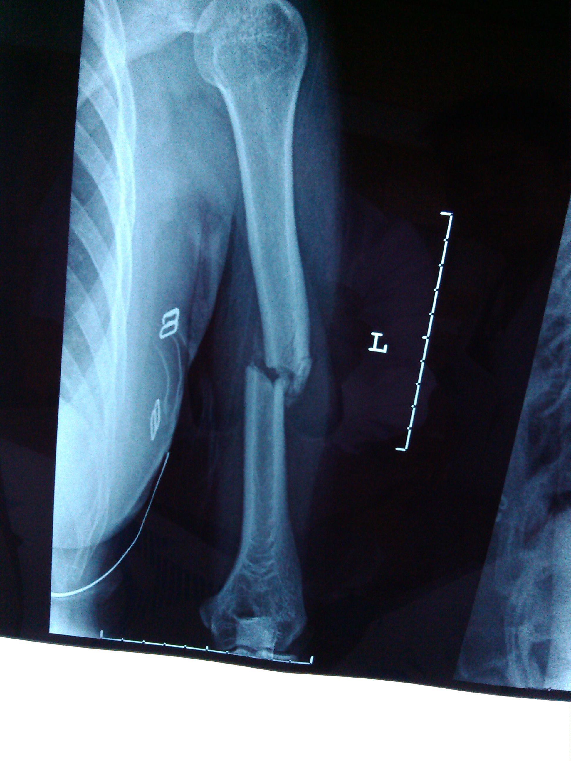 左肱骨上段骨折的图片图片