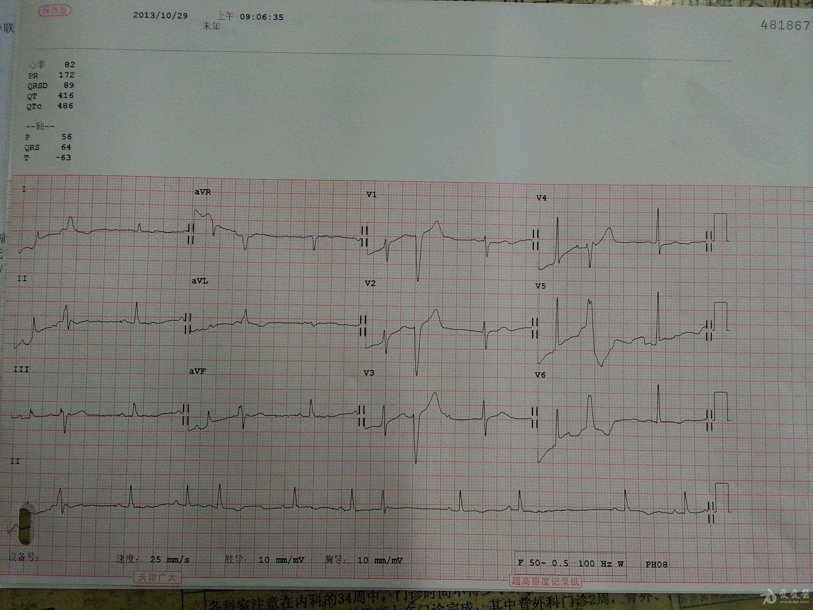同一患者心电图2