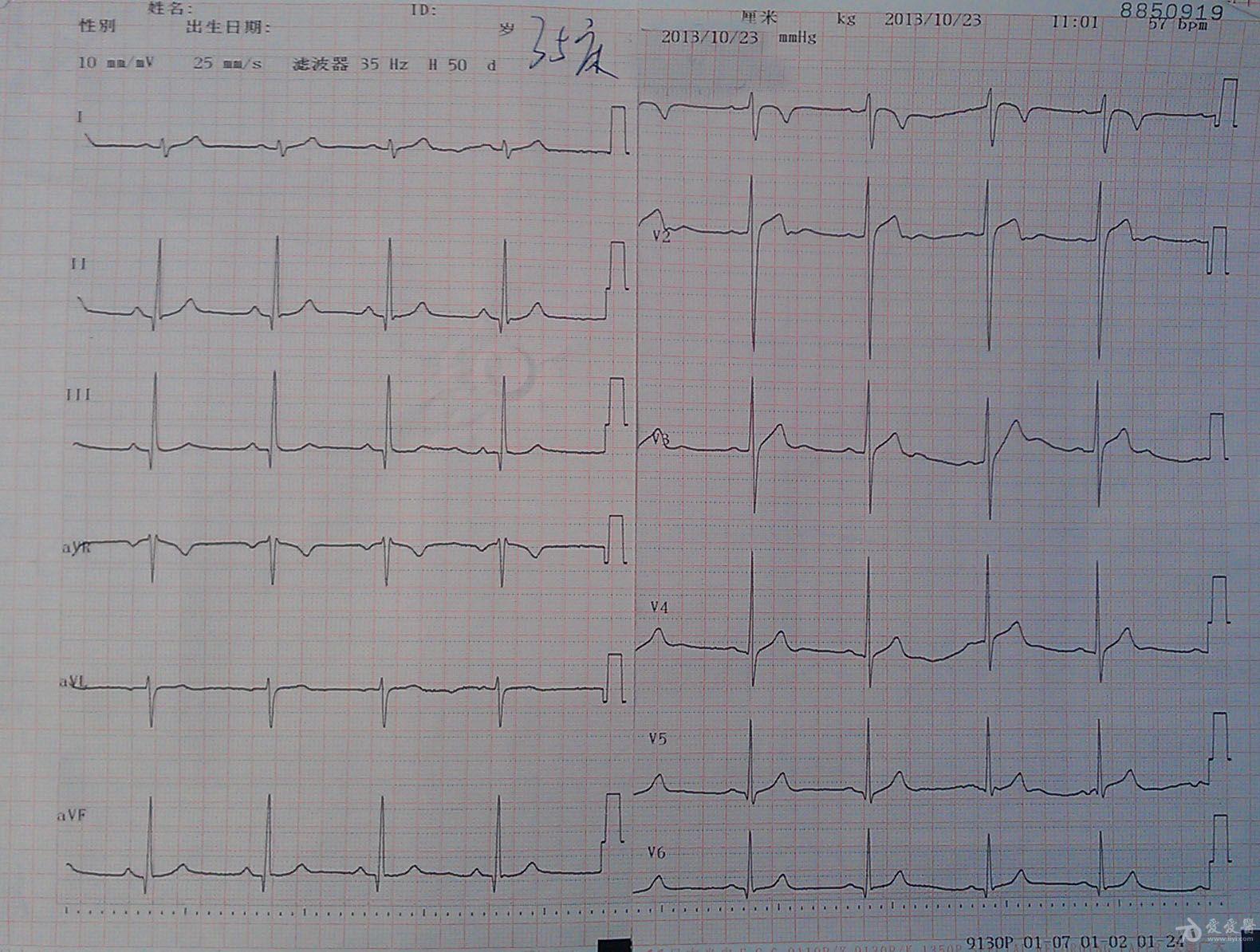 疑似brugada 综合症,请山羊老师及各位老师分析 - 心电图脑电图专业