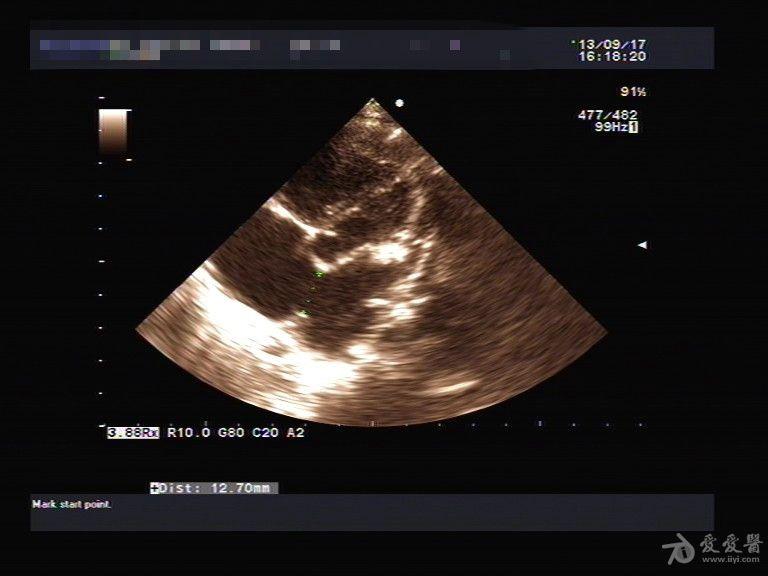 先心病房间隔缺损一例. - 超声医学讨论版 - 爱爱医医学论坛