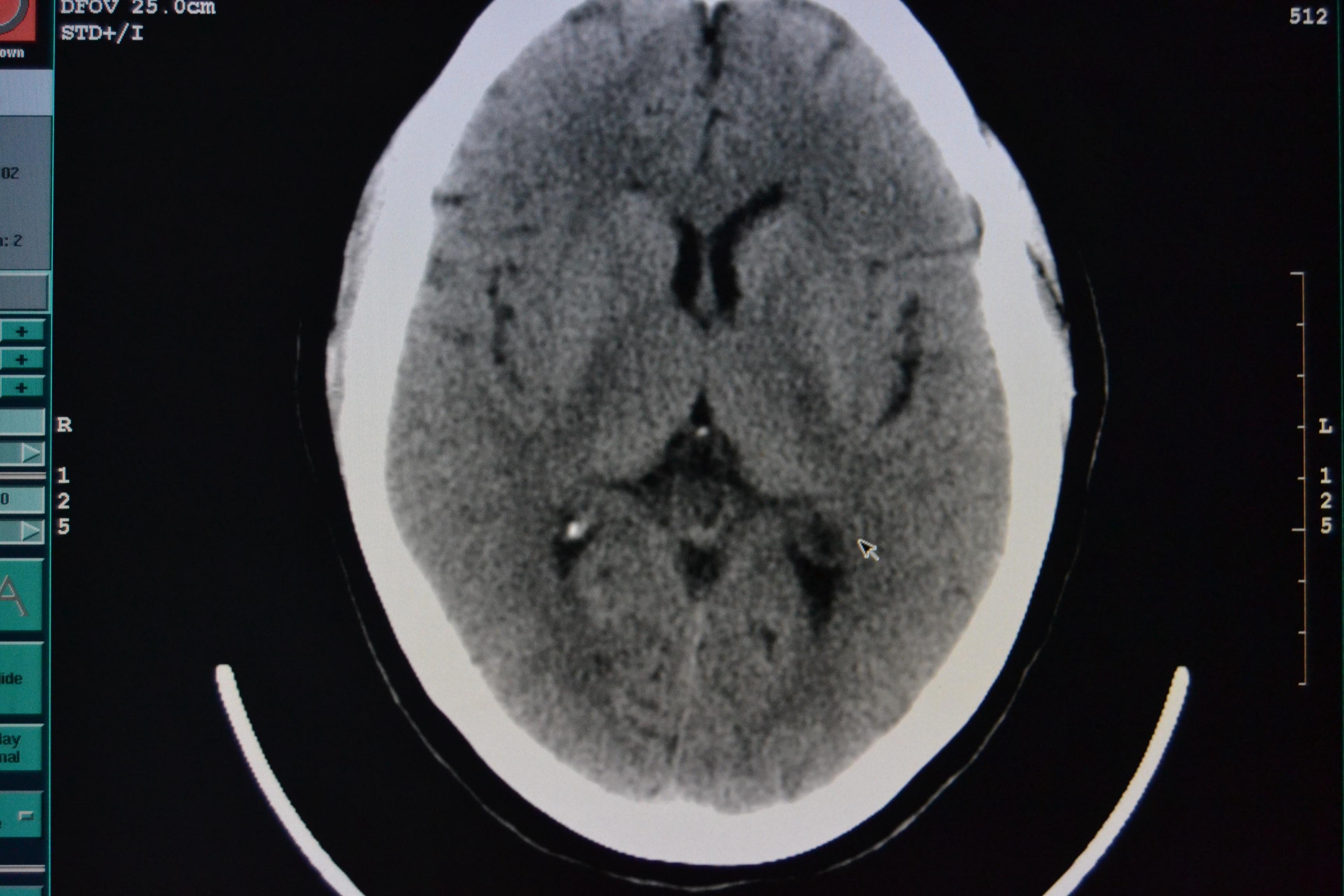 緊急求助 誰幫我看一下這個腦ct - 醫學影像學討論版 - 愛愛醫醫學