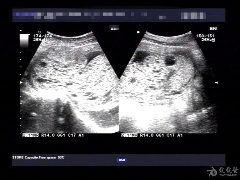 典型葡萄胎图像 超声医学讨论版 爱爱医医学论坛