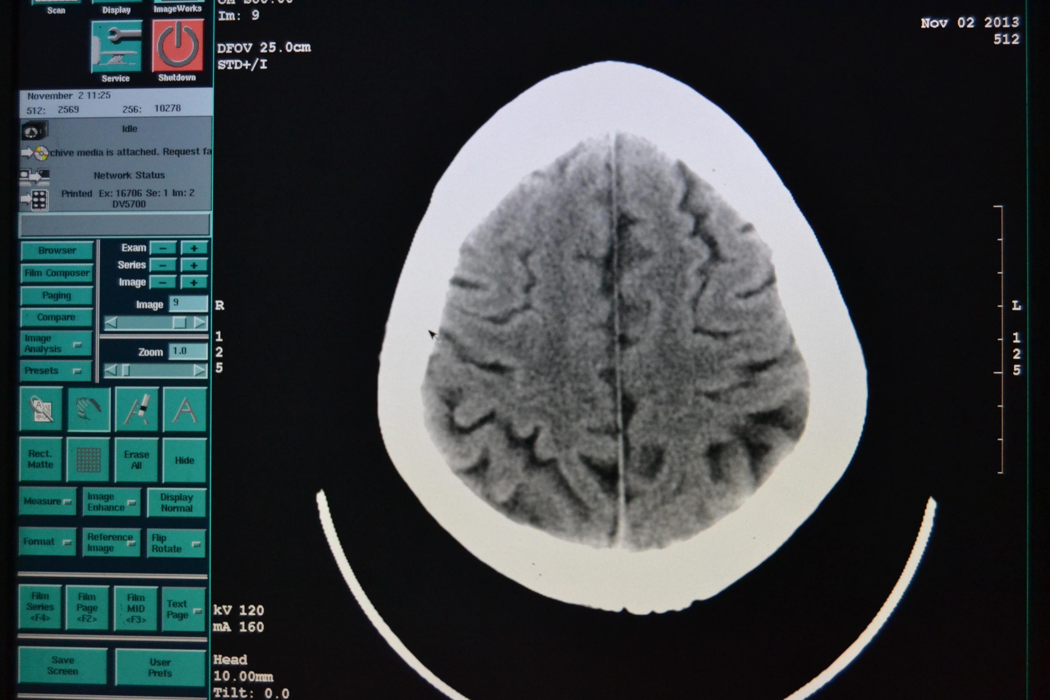 头颅ct看看透明隔