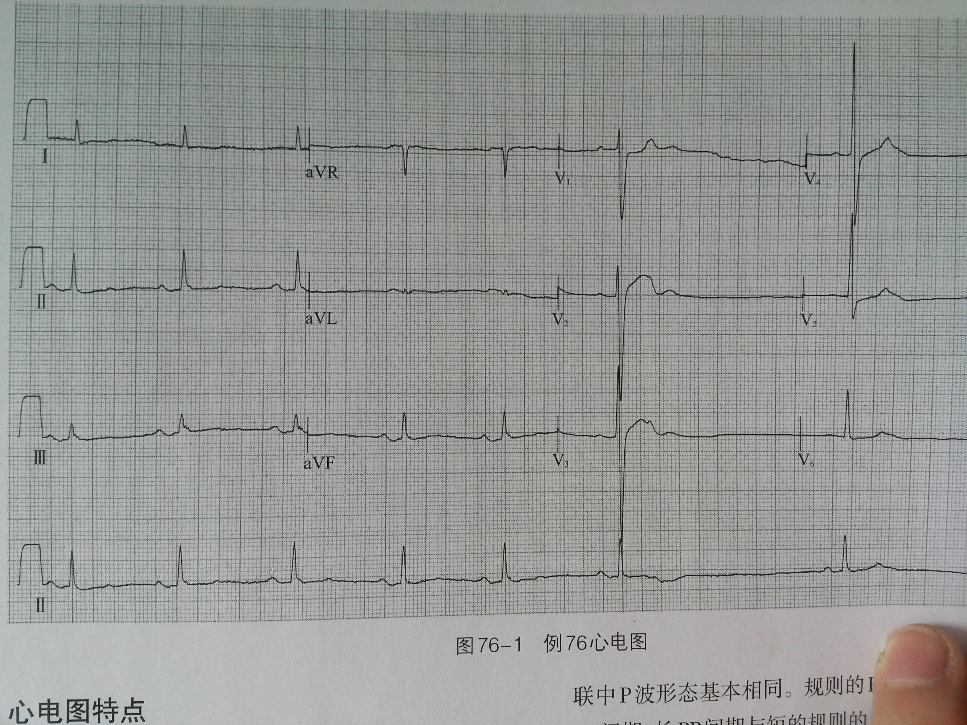 长rr间期多少算长rr