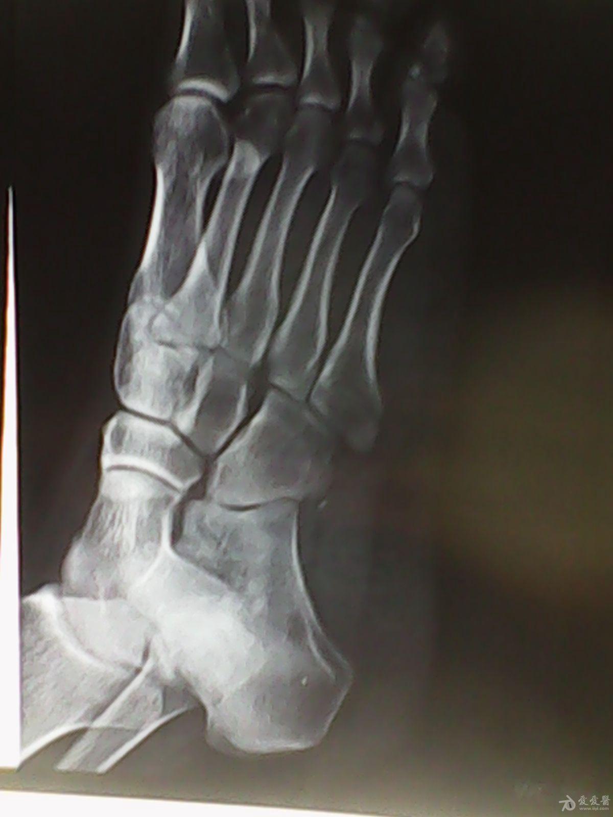 正常脚骨CT图,人体脚的骨骼结构图 - 伤感说说吧