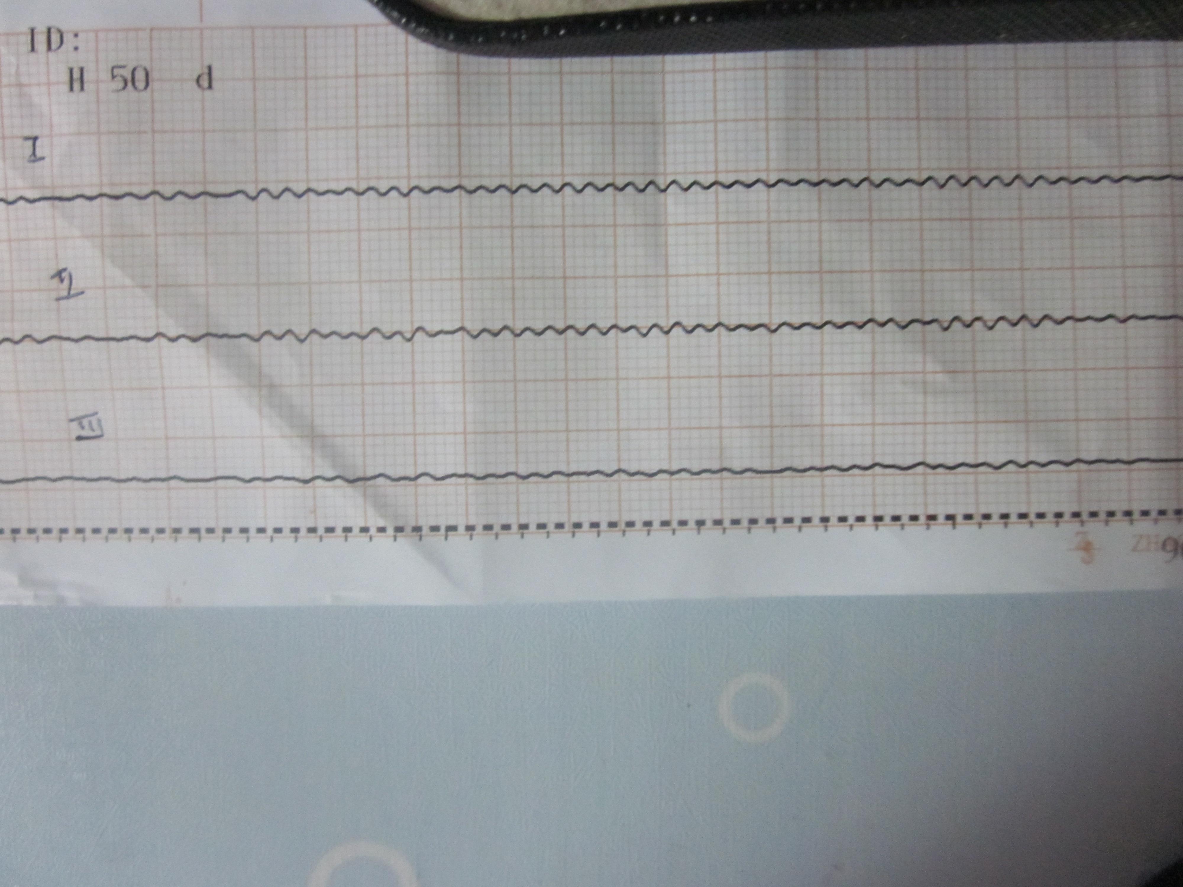 临终病人的心电图样子图片