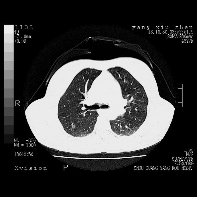 請幫忙看看這個肺部ct結節像什麼急盼謝謝