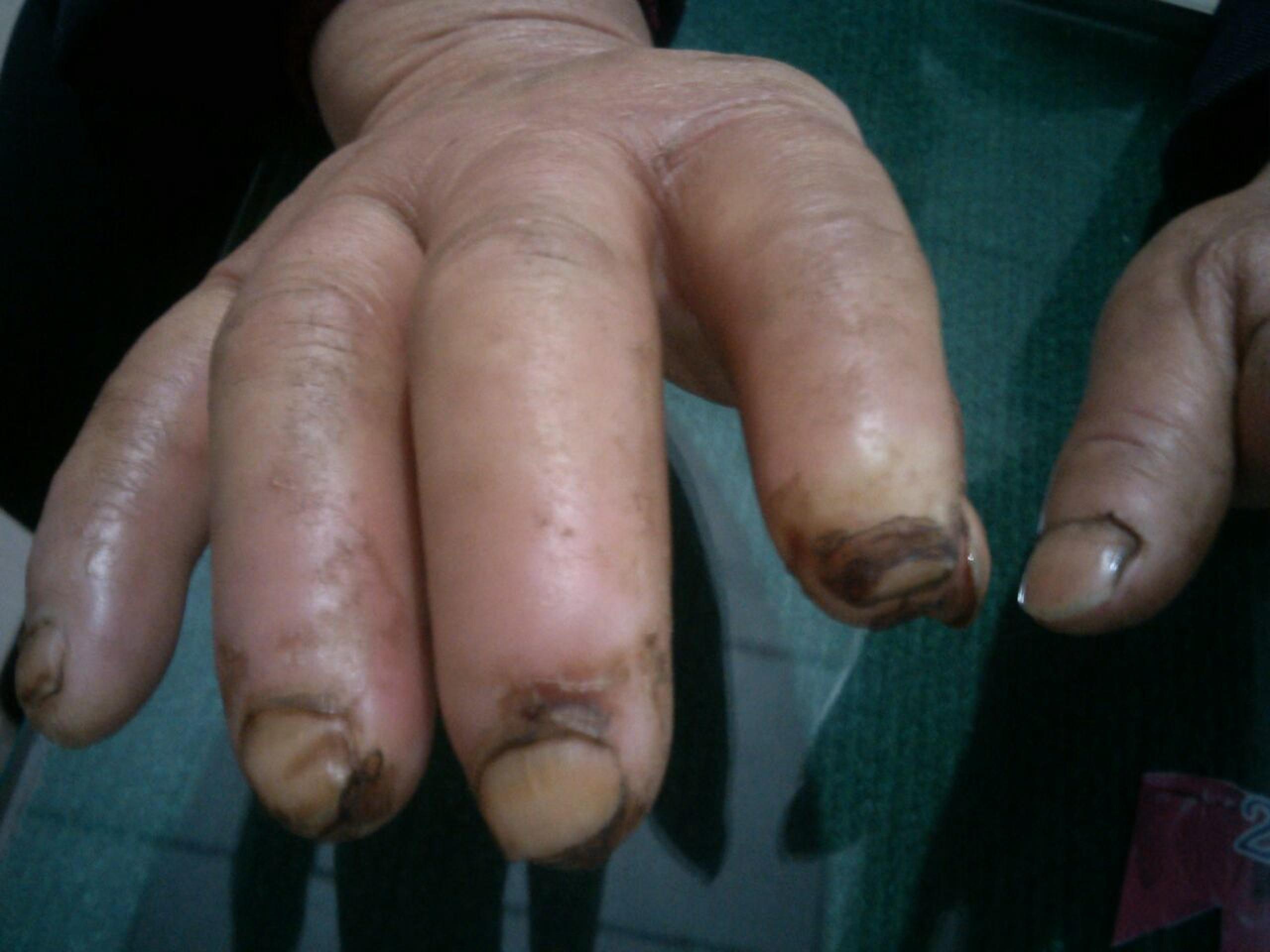 为什么叫雷诺氏综合征 1311100904ee21e7008cd1a477.jpg