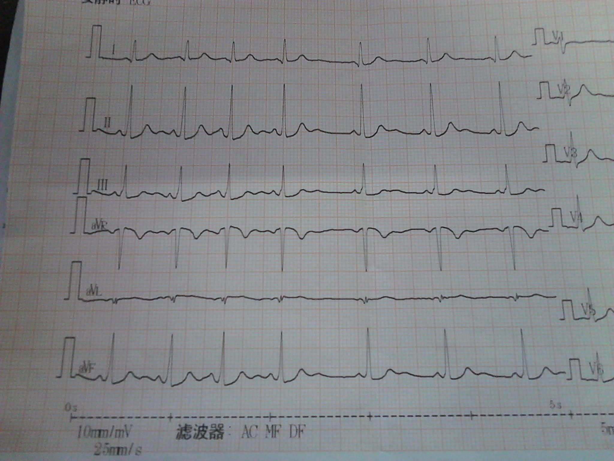 求大家看看這份心電圖
