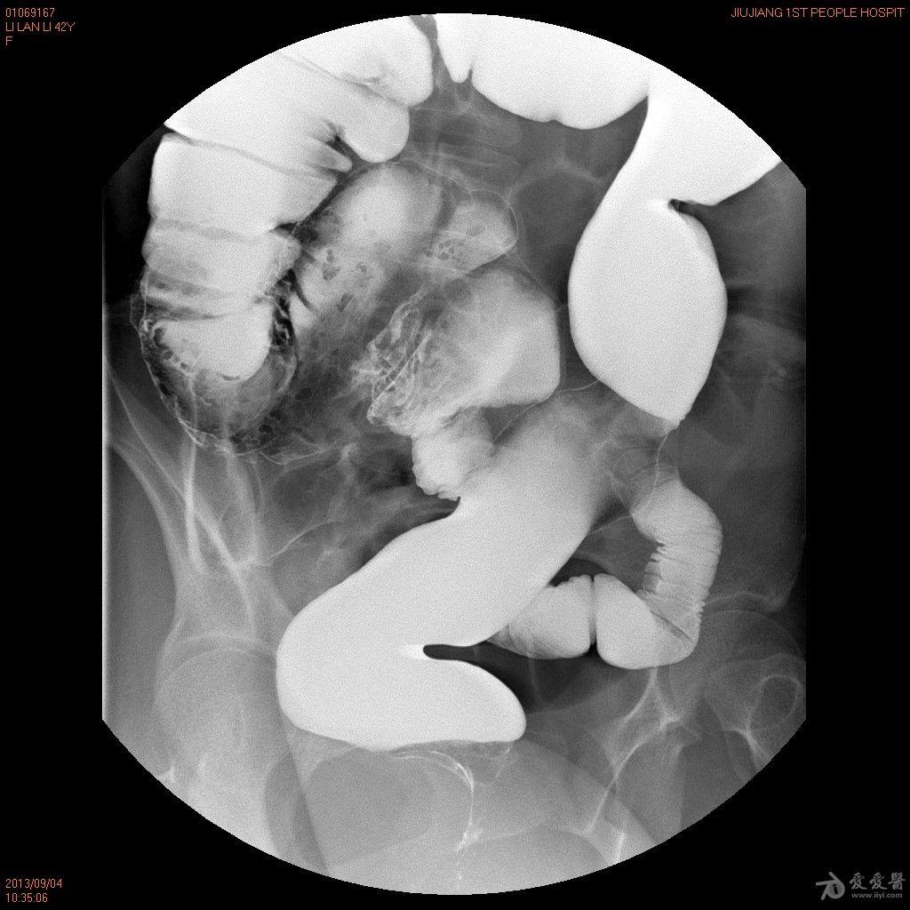 术前钡灌肠造影