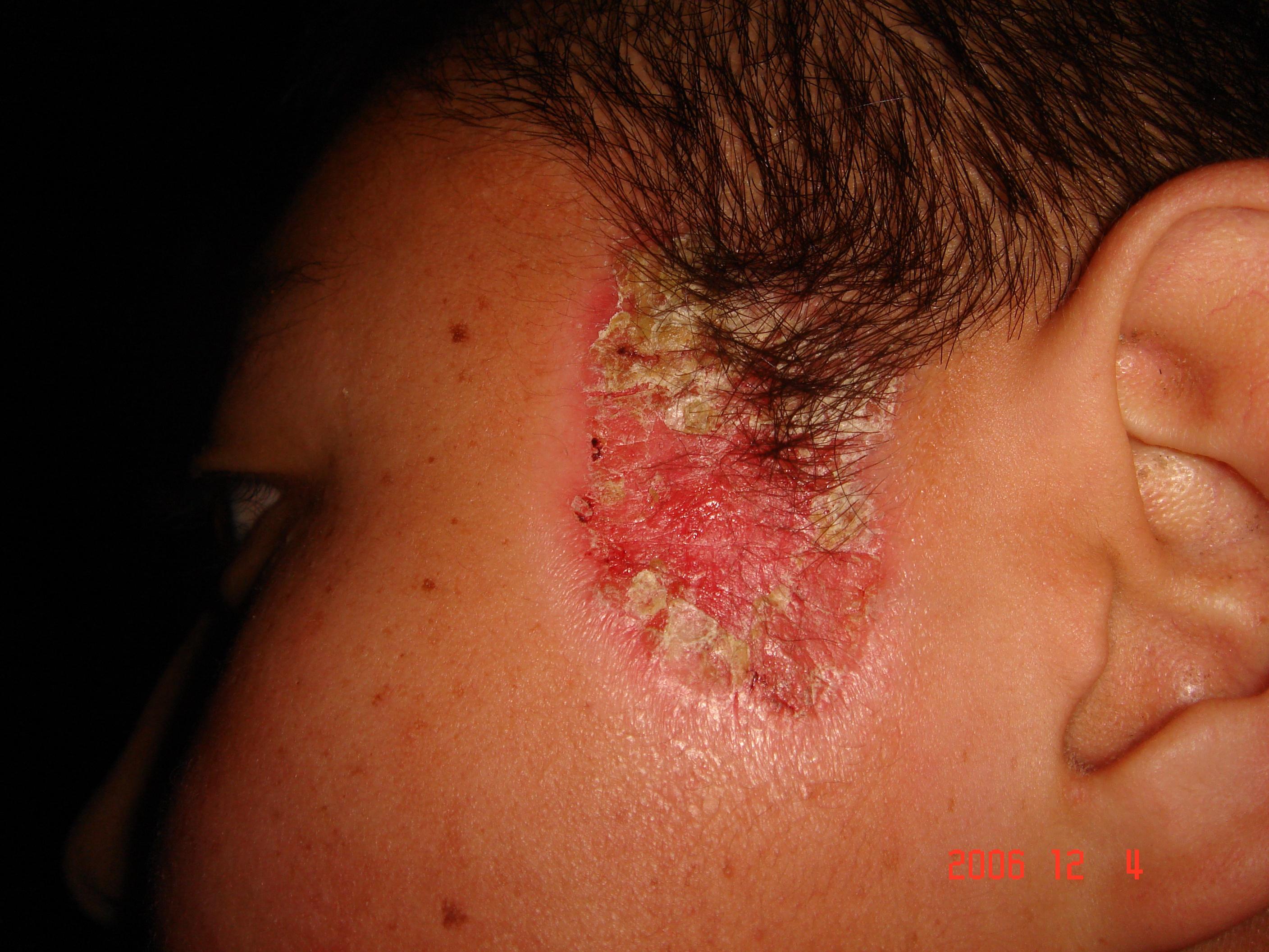 皮肤病银屑病图片