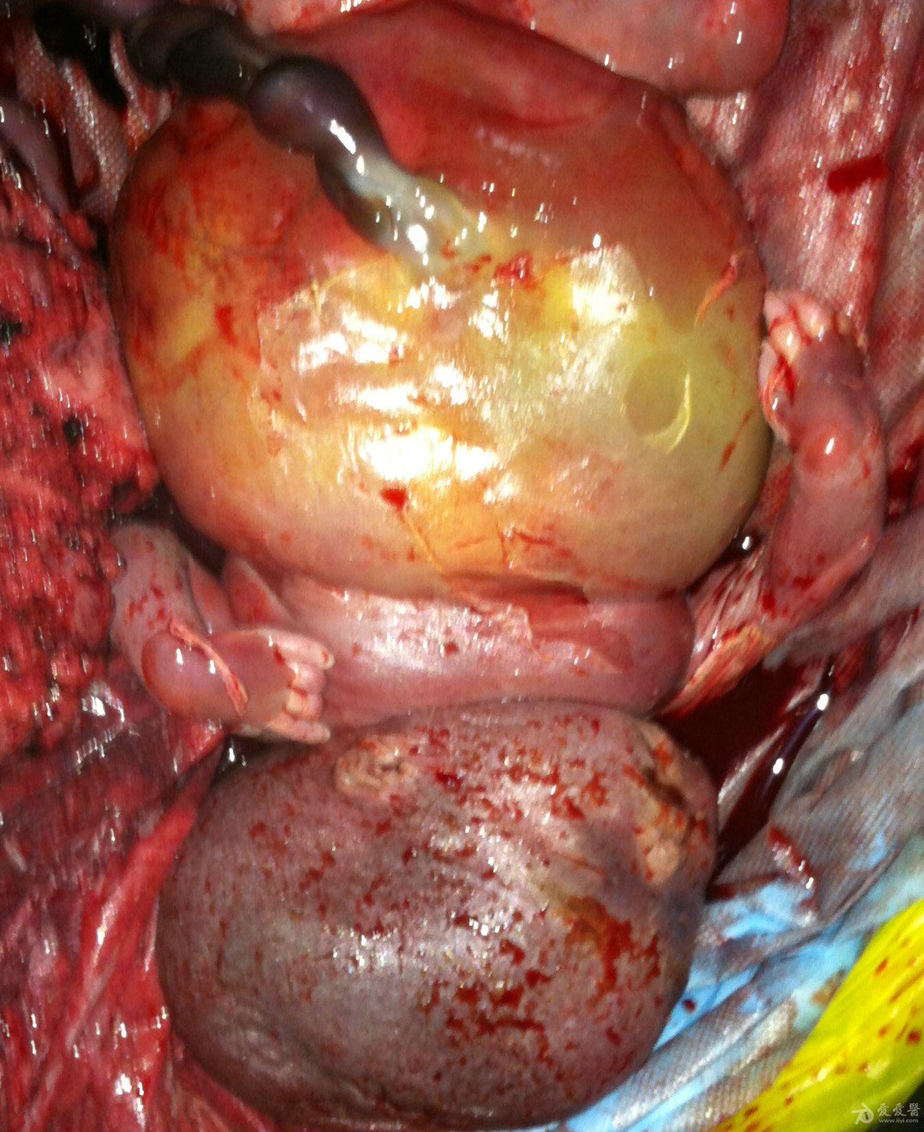 胎儿胸腹腔积液巨大胎盘